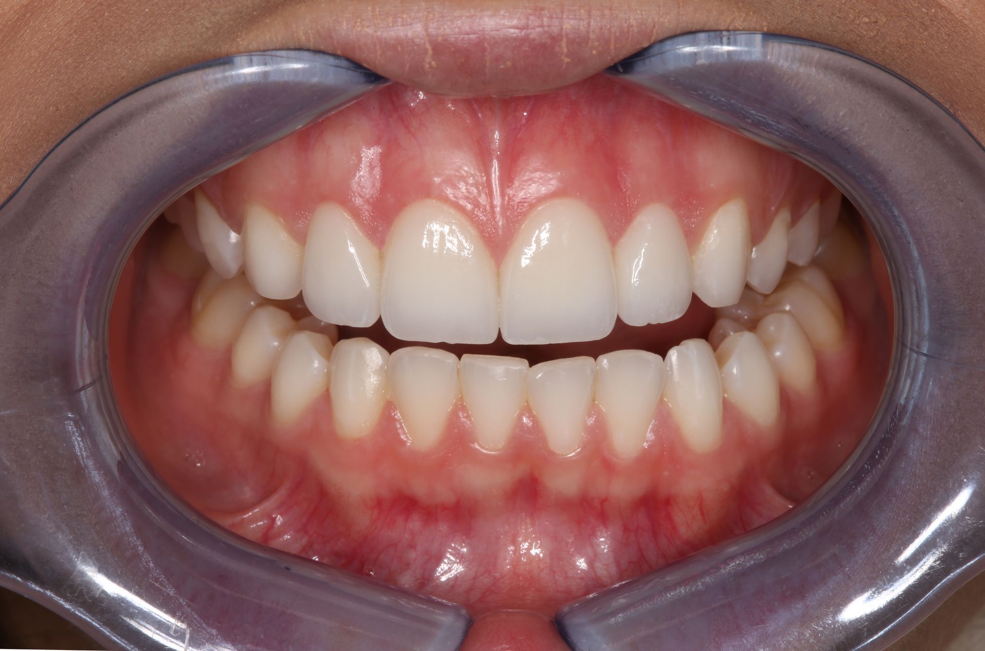 A close-up view of a person's teeth and gums, held open by a plastic retractor for a dental examination.