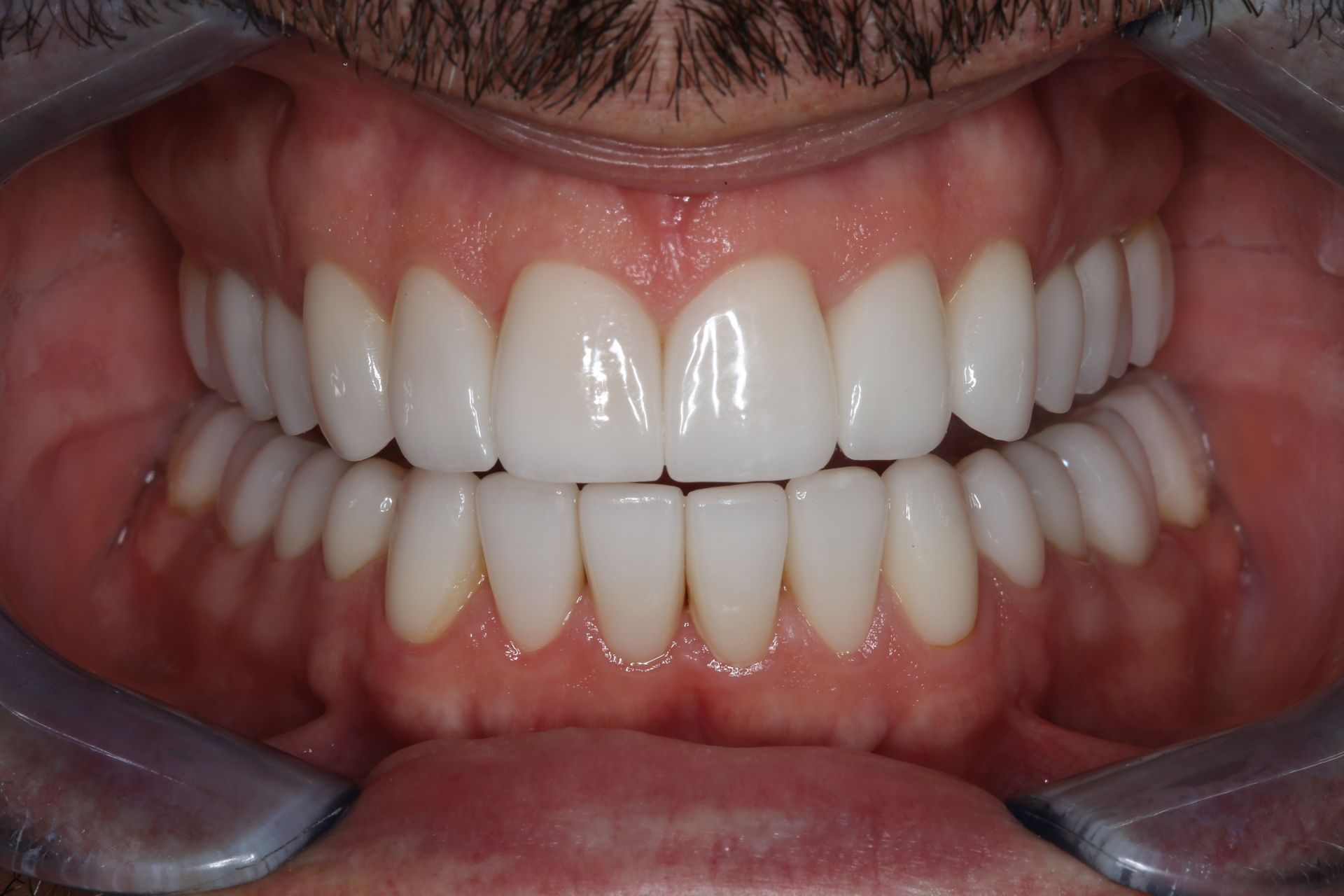 A close-up view of a person's upper and lower teeth, showing a straight, white, and healthy smile.