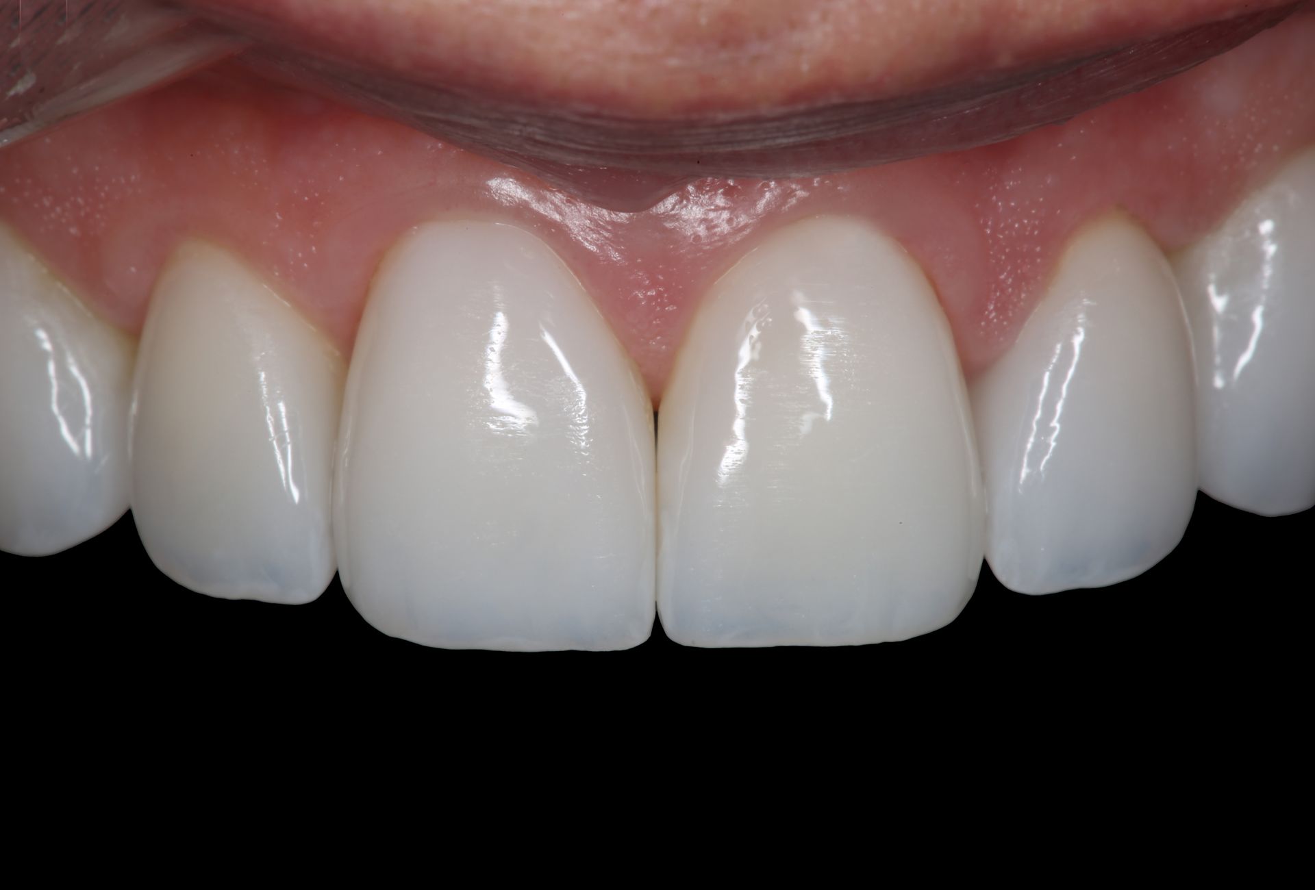 A close-up view of a person's upper front teeth, showing bright white dental crowns or veneers against a black background.