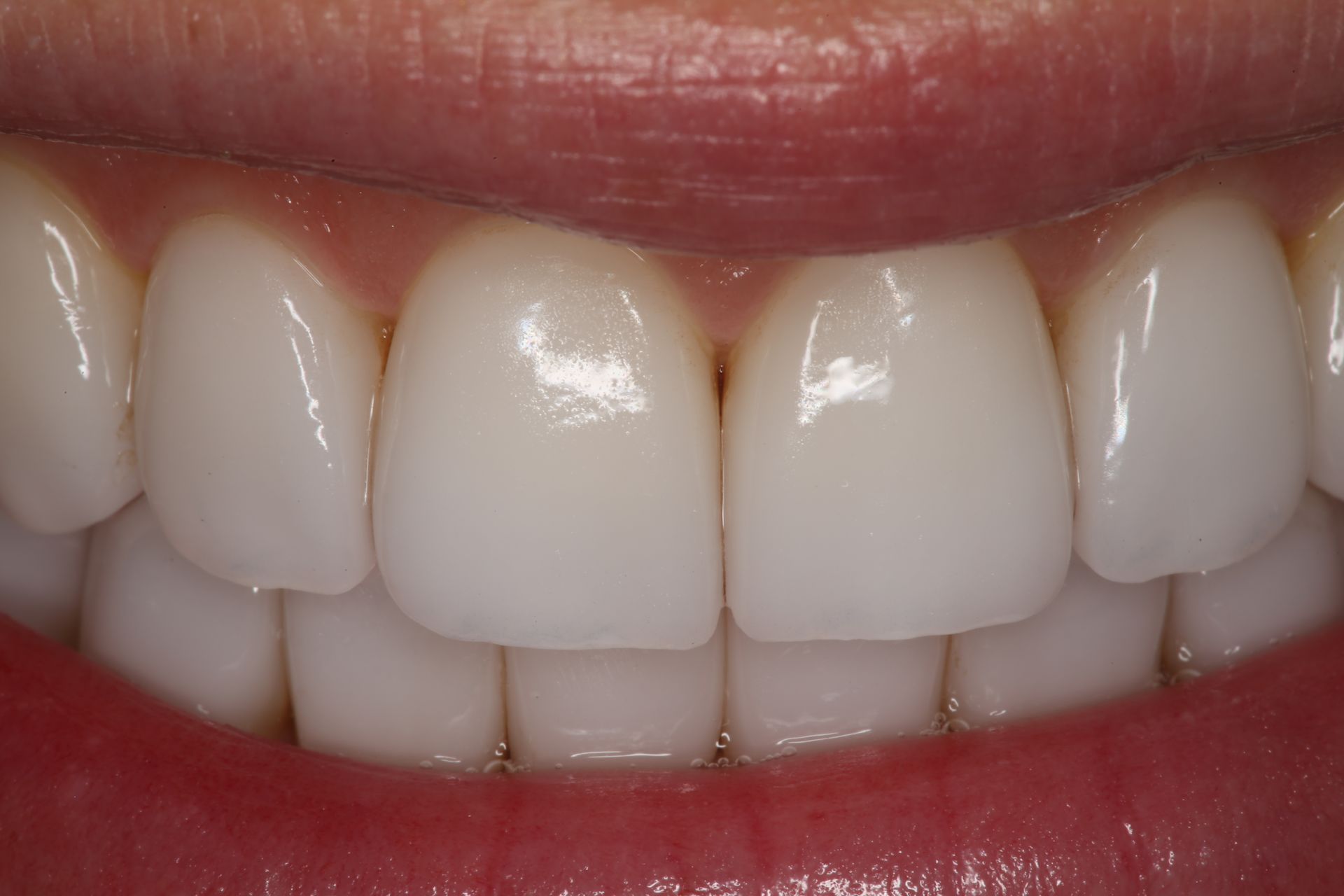 Close-up view of a person’s clean, white teeth and upper lip in a smile.