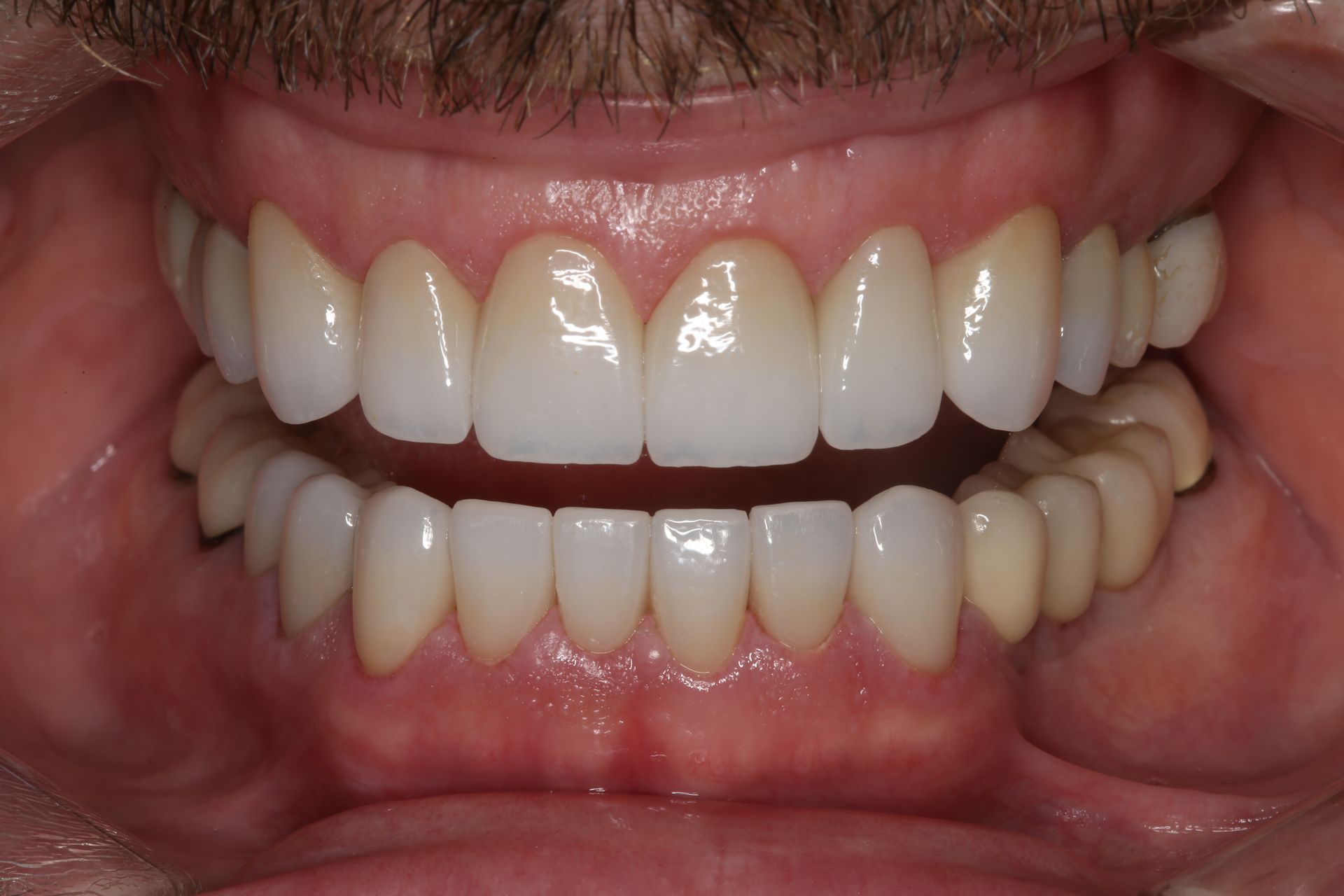 Close-up of a person's upper and lower teeth, showing a smile with dental crowns or veneers.