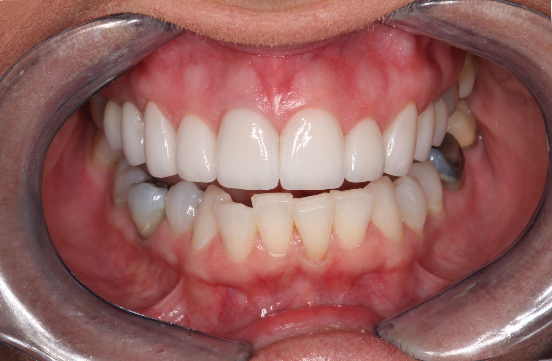 A close-up view of teeth held open by a retractor, showing upper ceramic veneers and lower crowded natural teeth.