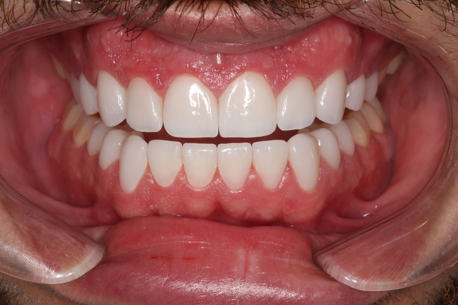 Close-up of a person's mouth showing straight, clean, white teeth with healthy pink gums.