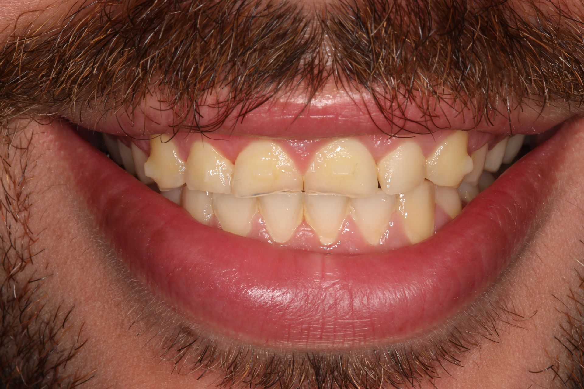 Close-up view of a person’s lower face showing their teeth while smiling, with a mustache above the upper lip.