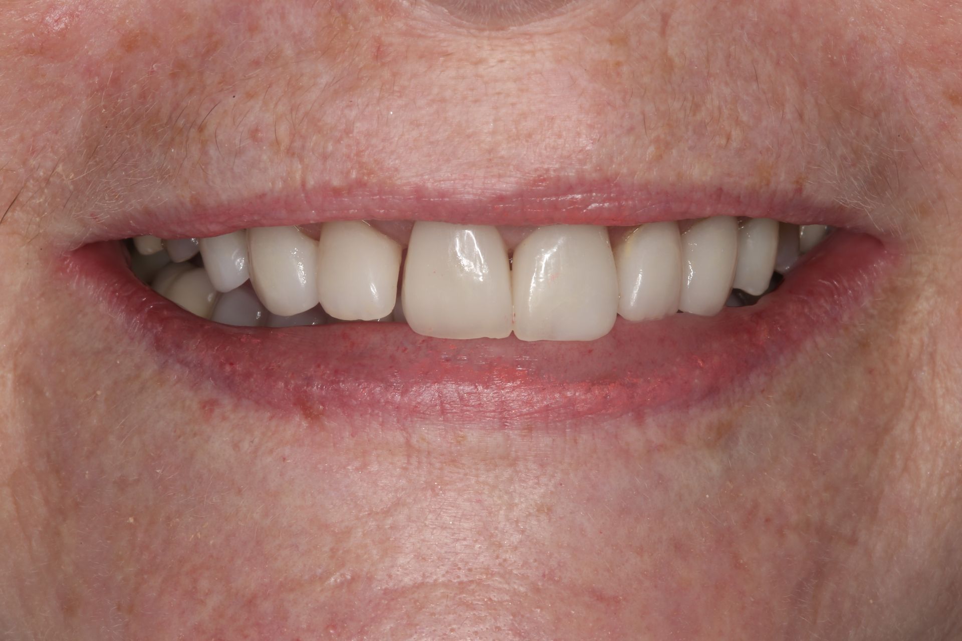 A close-up view of a smiling mouth, showing natural, white teeth and pink gums.