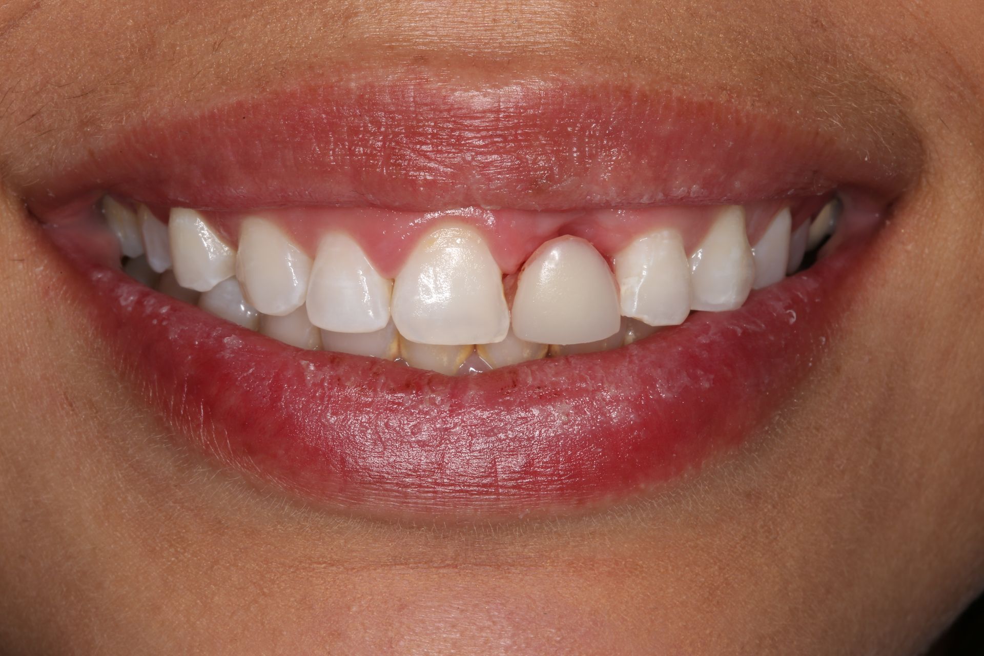 A close-up of a person's smile, focusing on the upper teeth and gums.