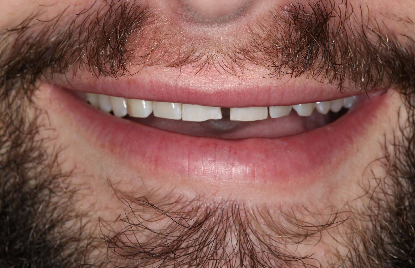 A person’s mouth showing a slight gap between the two front teeth while smiling.
