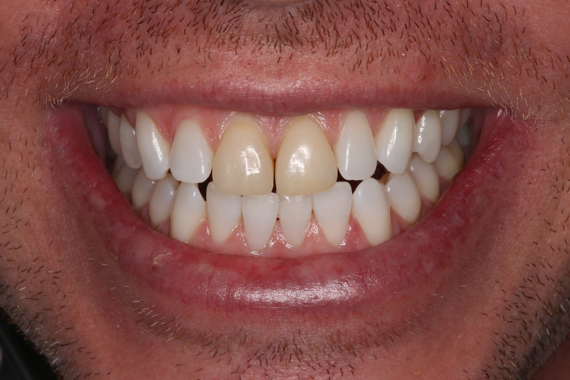 Close-up of a smiling mouth showing two discolored, yellowish upper front teeth among whiter surrounding teeth.