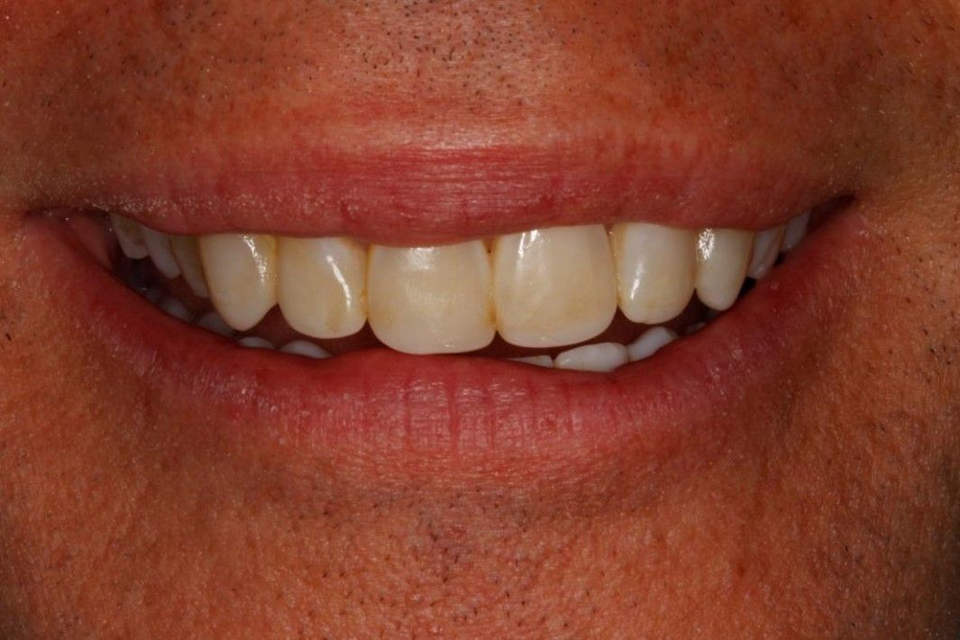 Close-up view of a person’s mouth, showing a full set of natural-colored teeth in a slight smile.