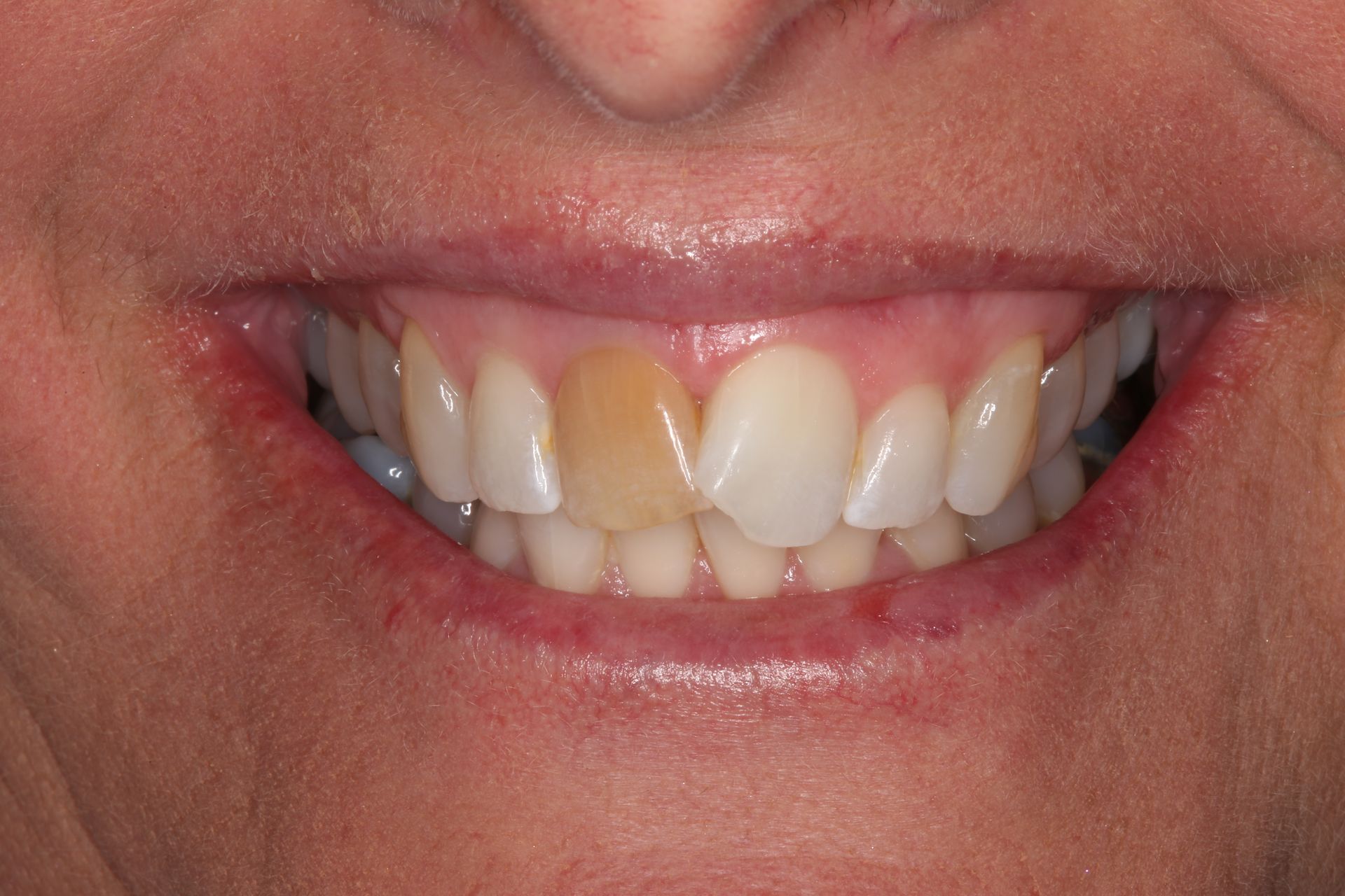 A close-up of a person's smiling mouth, highlighting a single dark, discolored upper front tooth among lighter teeth.