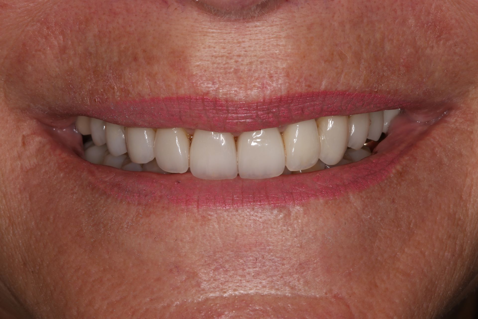 A close-up of a person smiling, showing a full set of white, uniform upper teeth.