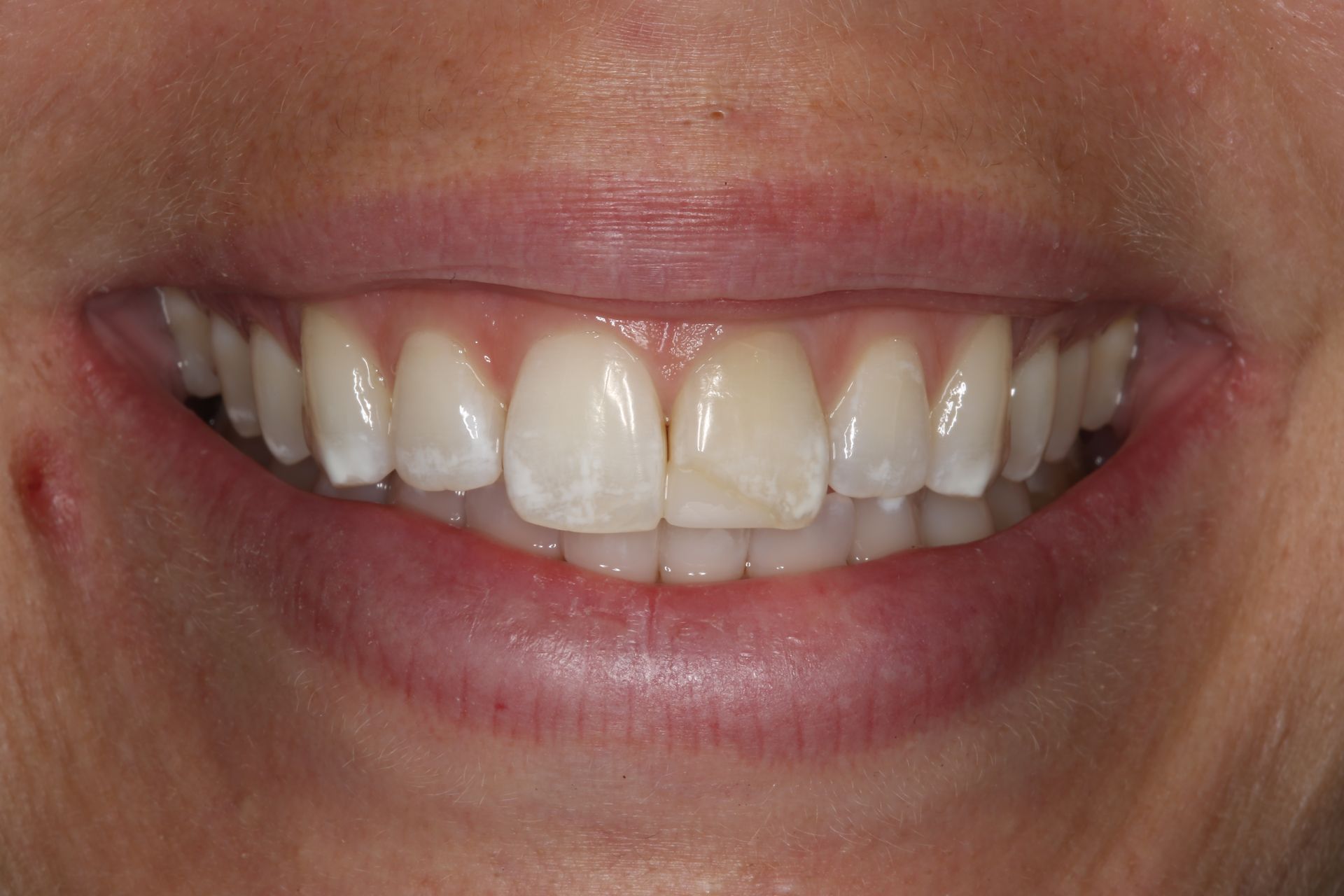 A close-up of a person's smile, showing teeth with some enamel discoloration and minor chips on the front incisors.