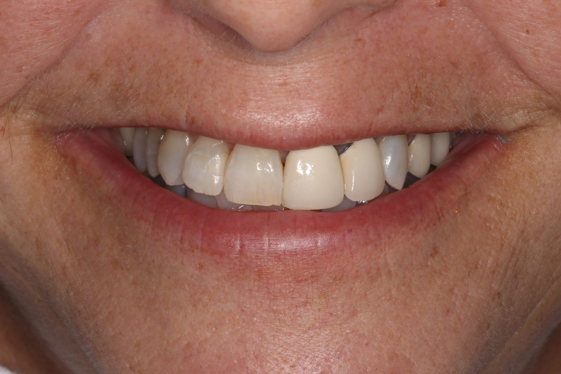 Close-up of a person’s smile showing natural teeth with a central dental crown.