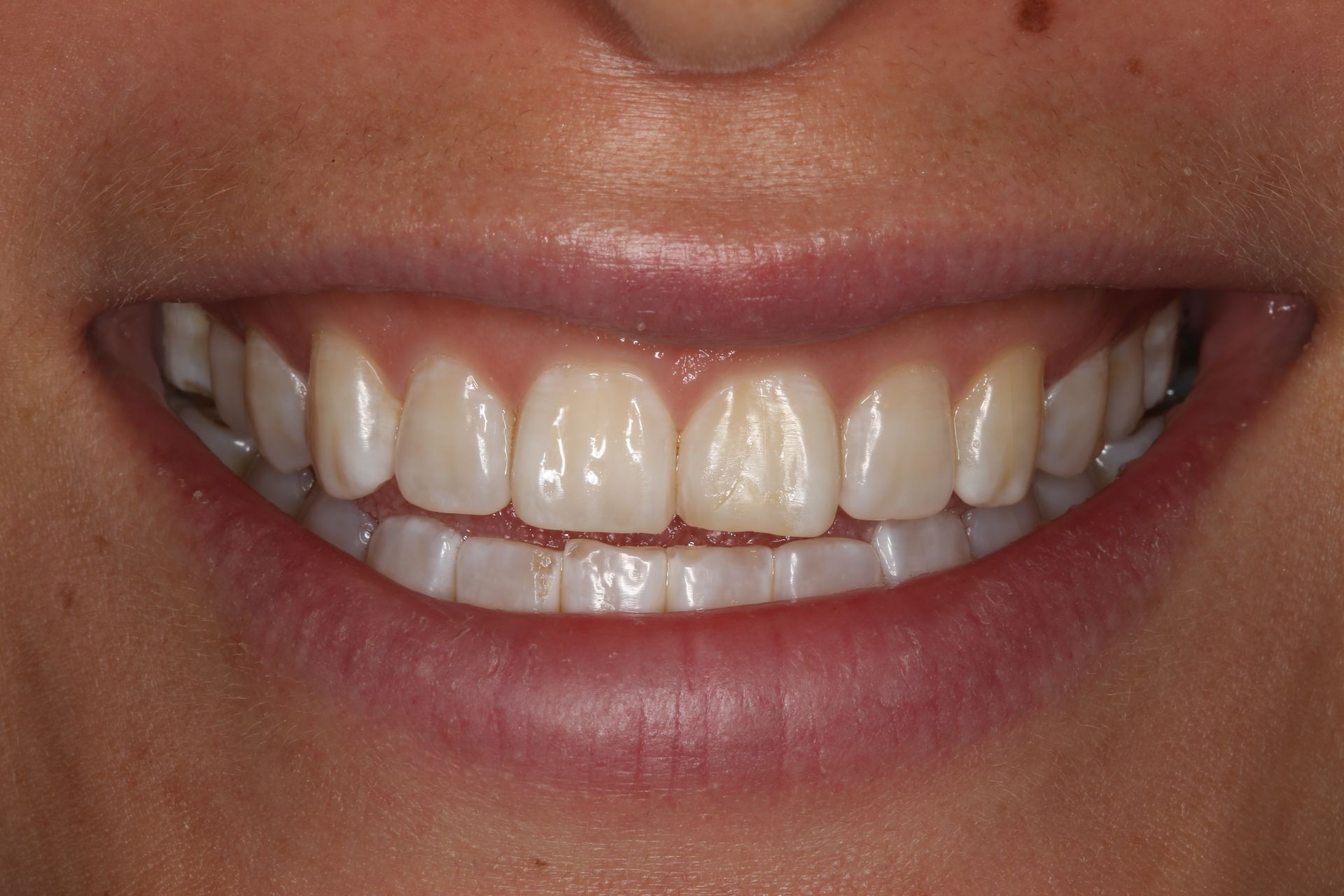 Close-up of a person’s lower face showing an even, natural smile with white, aligned teeth.