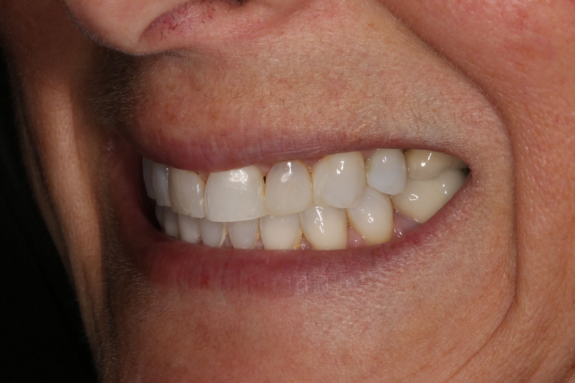 Close-up of a person's mouth showing a healthy, white smile with teeth slightly touching.
