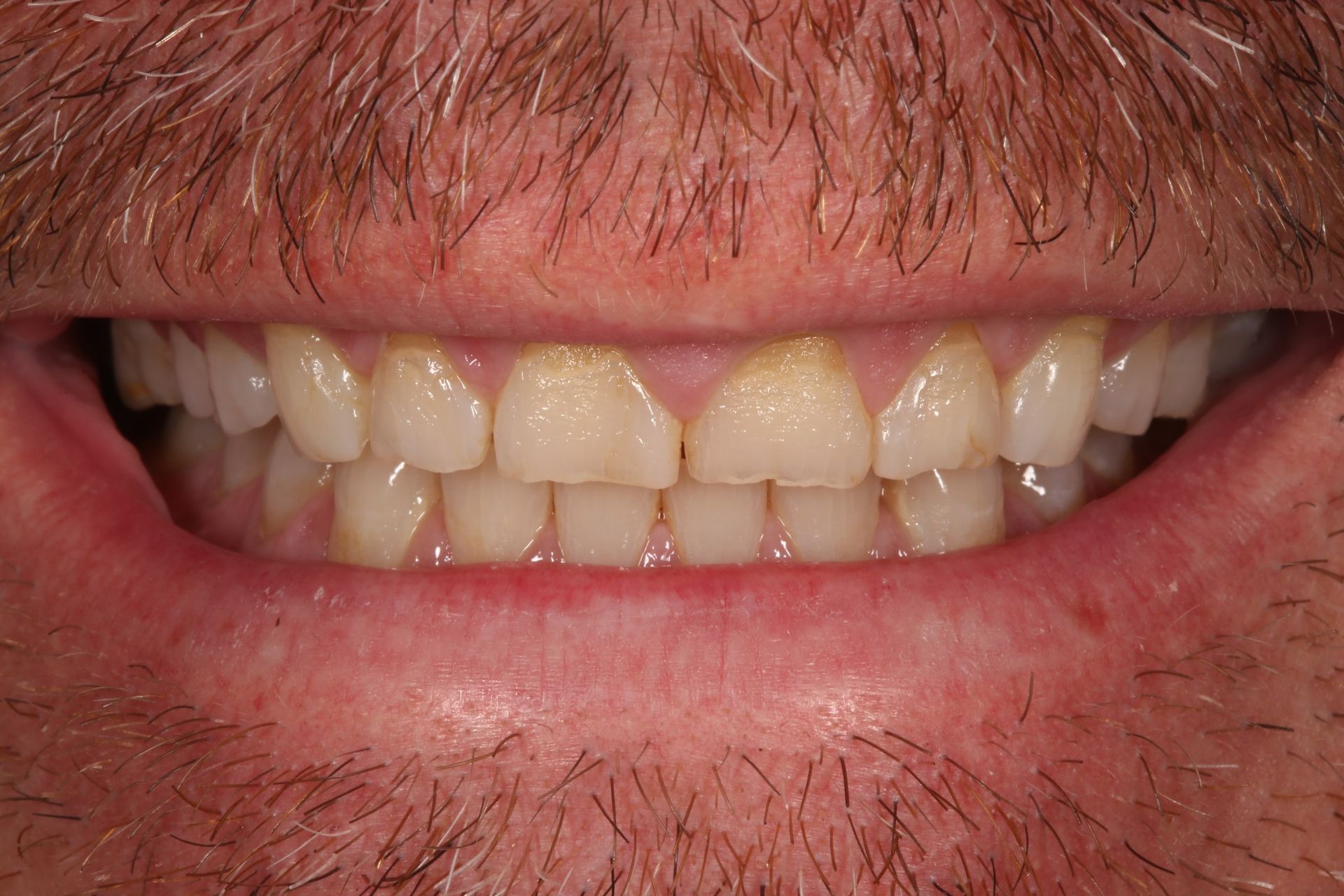 Close-up of a person's mouth showing teeth with visible wear, discolored edges, and uneven biting surfaces.