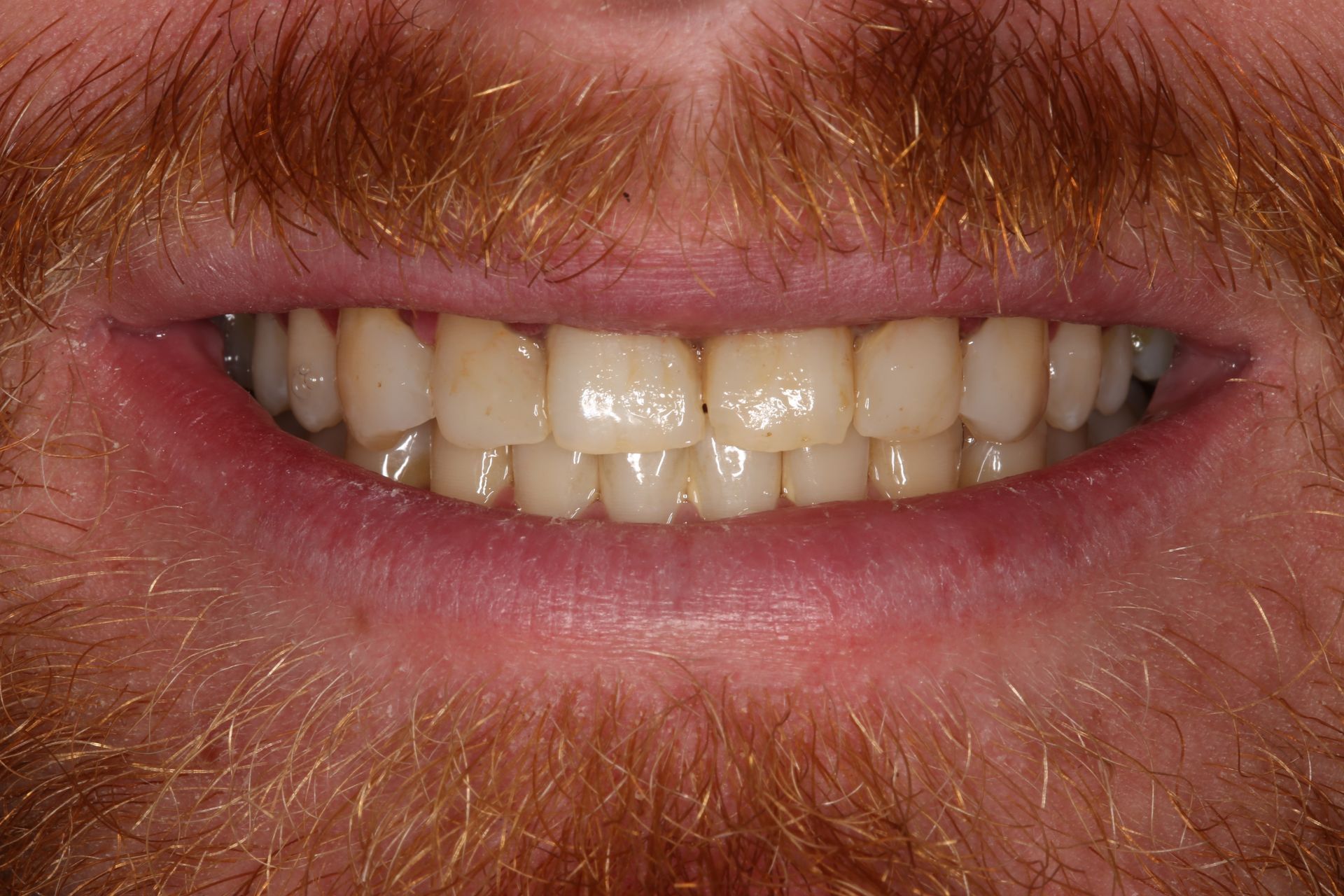 A close-up of a person’s lower face showing a gentle smile with their natural teeth and a reddish-brown beard.