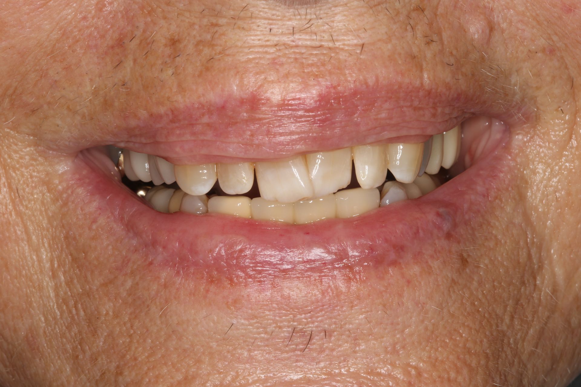 Close-up of a person's mouth and lower face, showing natural teeth with visible wear and yellowing, smiling slightly.