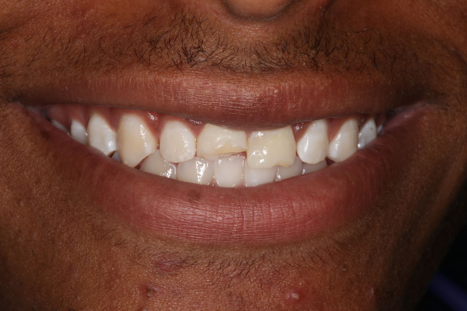 A close-up of a person's smile, showing slightly crowded upper front teeth with a minor chip on the central incisor.