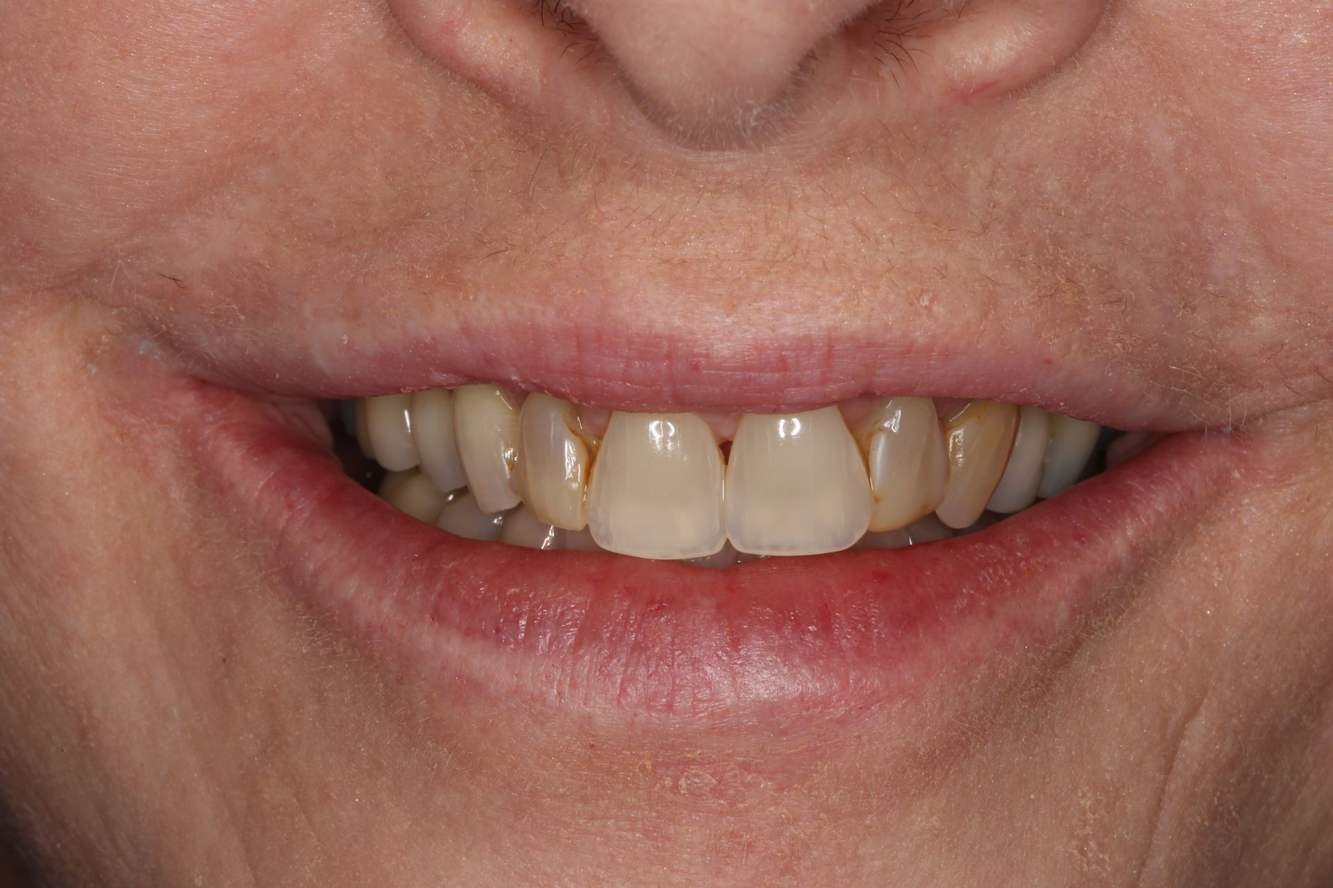A close-up view of a smiling mouth showing natural teeth with some yellowing and mild dental crowding.