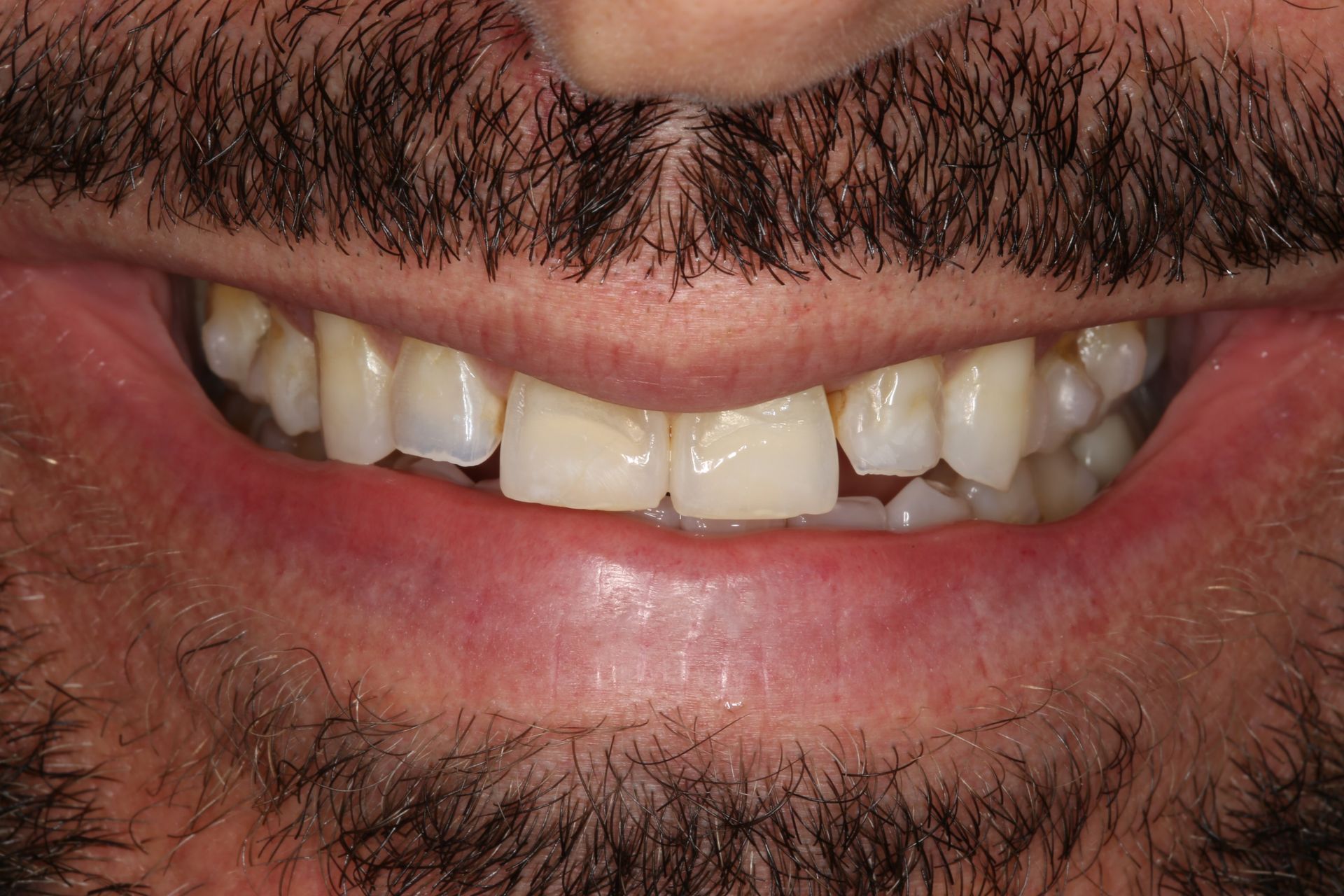 A close-up of a person's mouth displaying teeth with mild crowding and slightly uneven alignment.