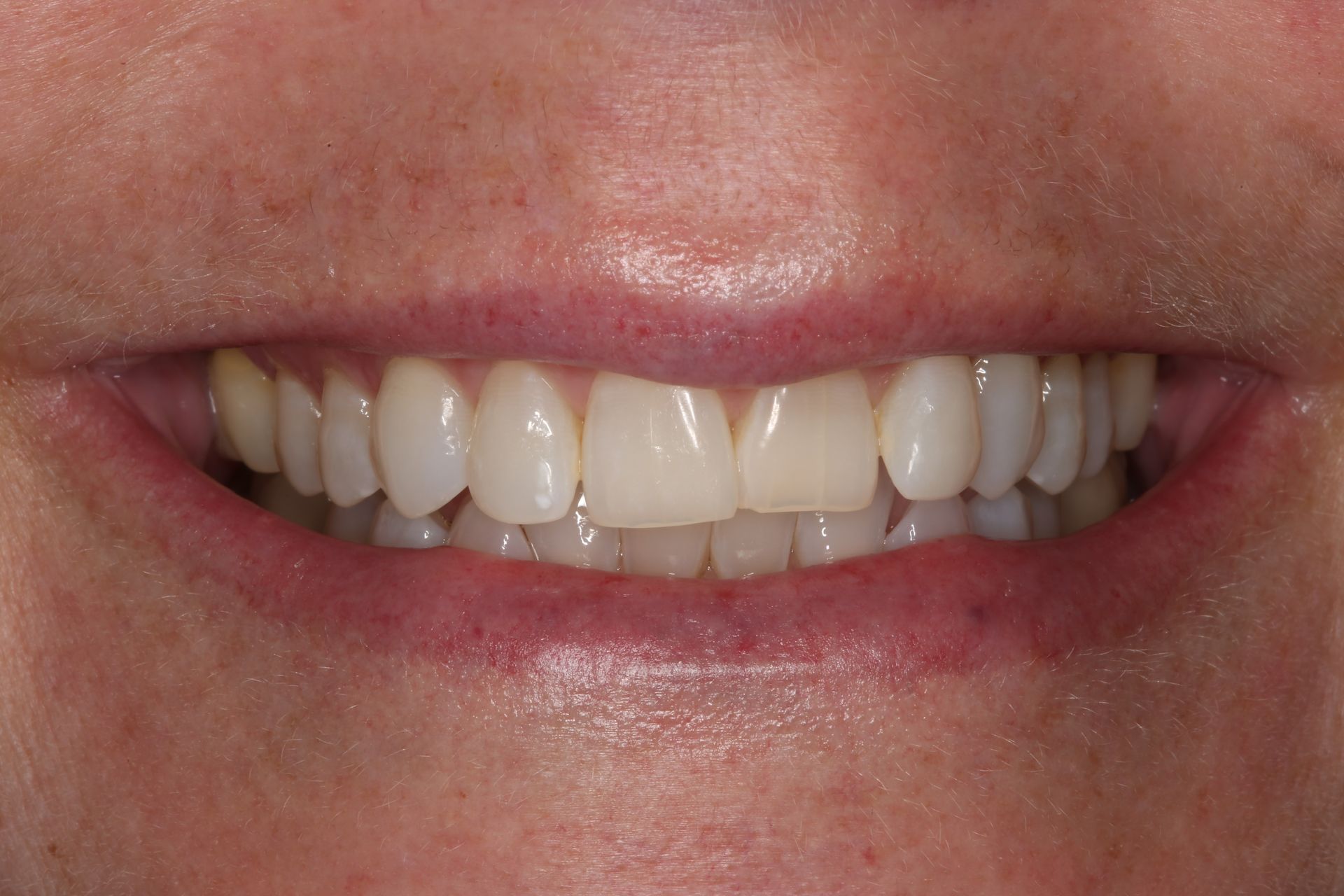 A close-up of a person's mouth with white, straight teeth visible while smiling.
