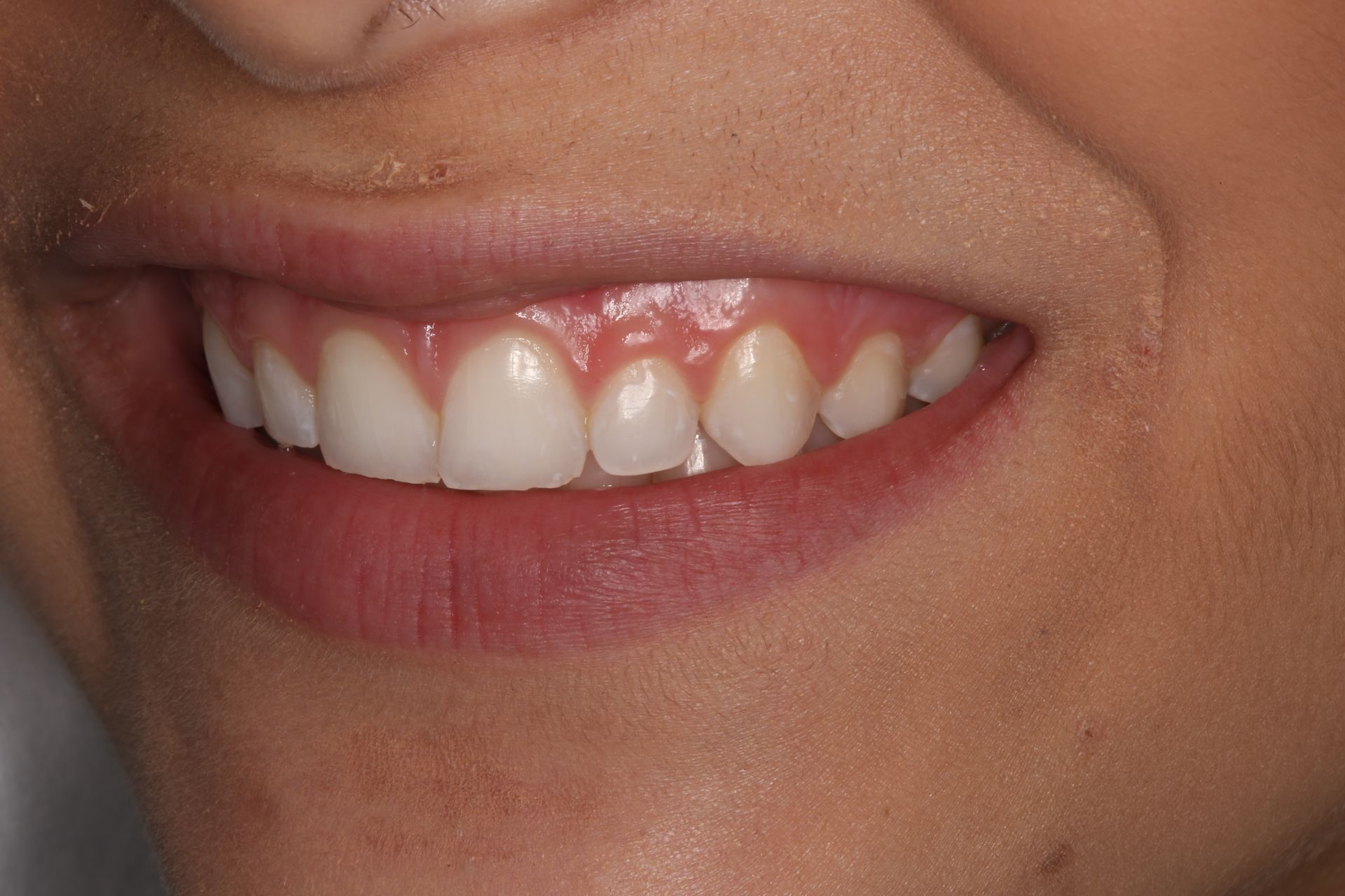 A close-up view of a smiling mouth, showing healthy teeth and gums.