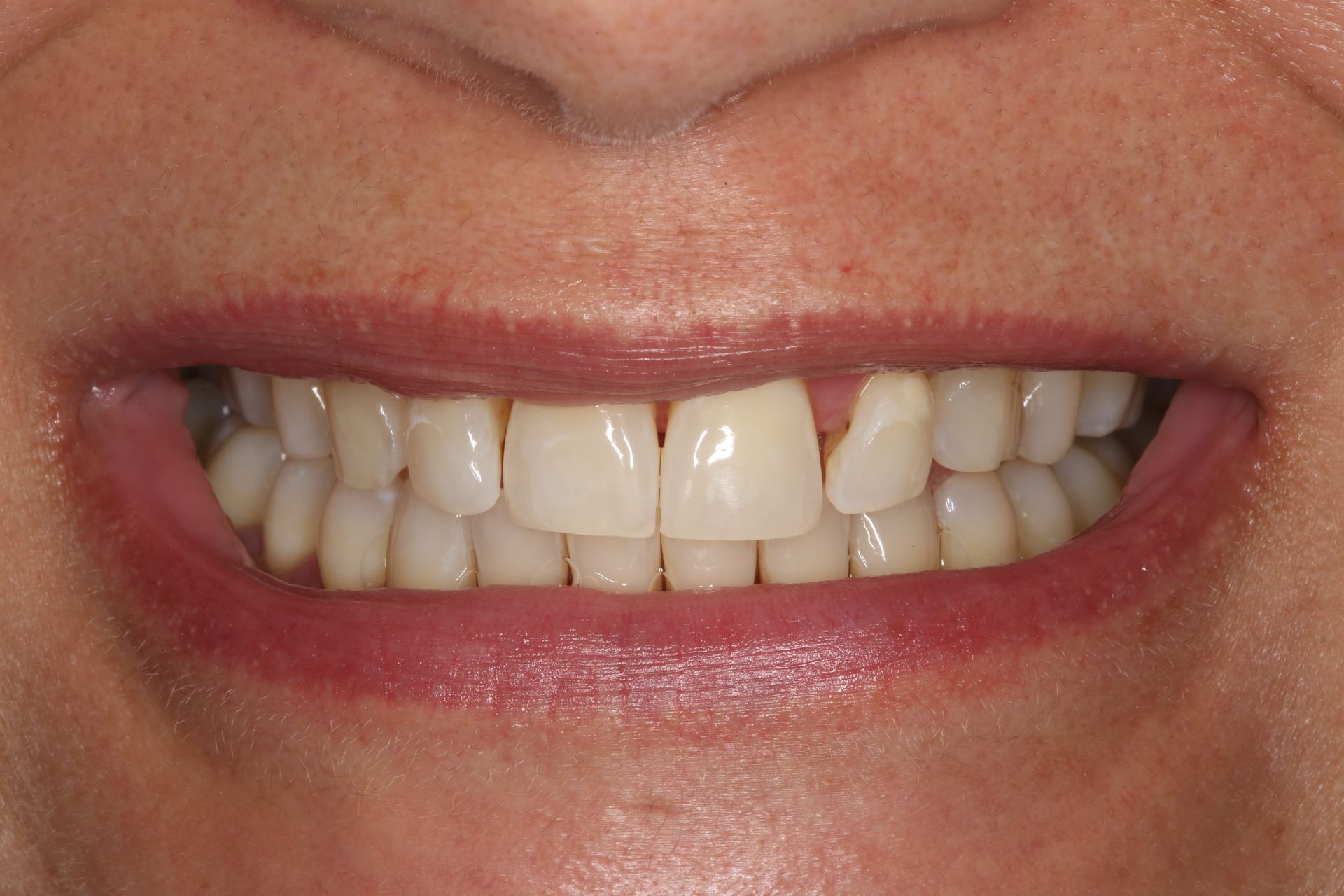 Close-up of a person's mouth showing teeth with a small gap between the two front upper teeth and a chipped tooth.
