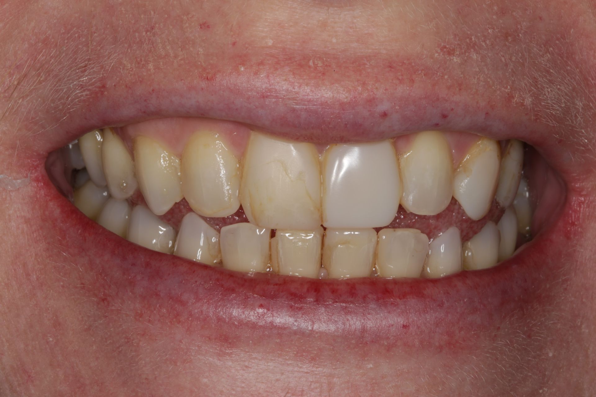 A close-up of a person's teeth showing slight misalignment and color variation between the front two central incisors.