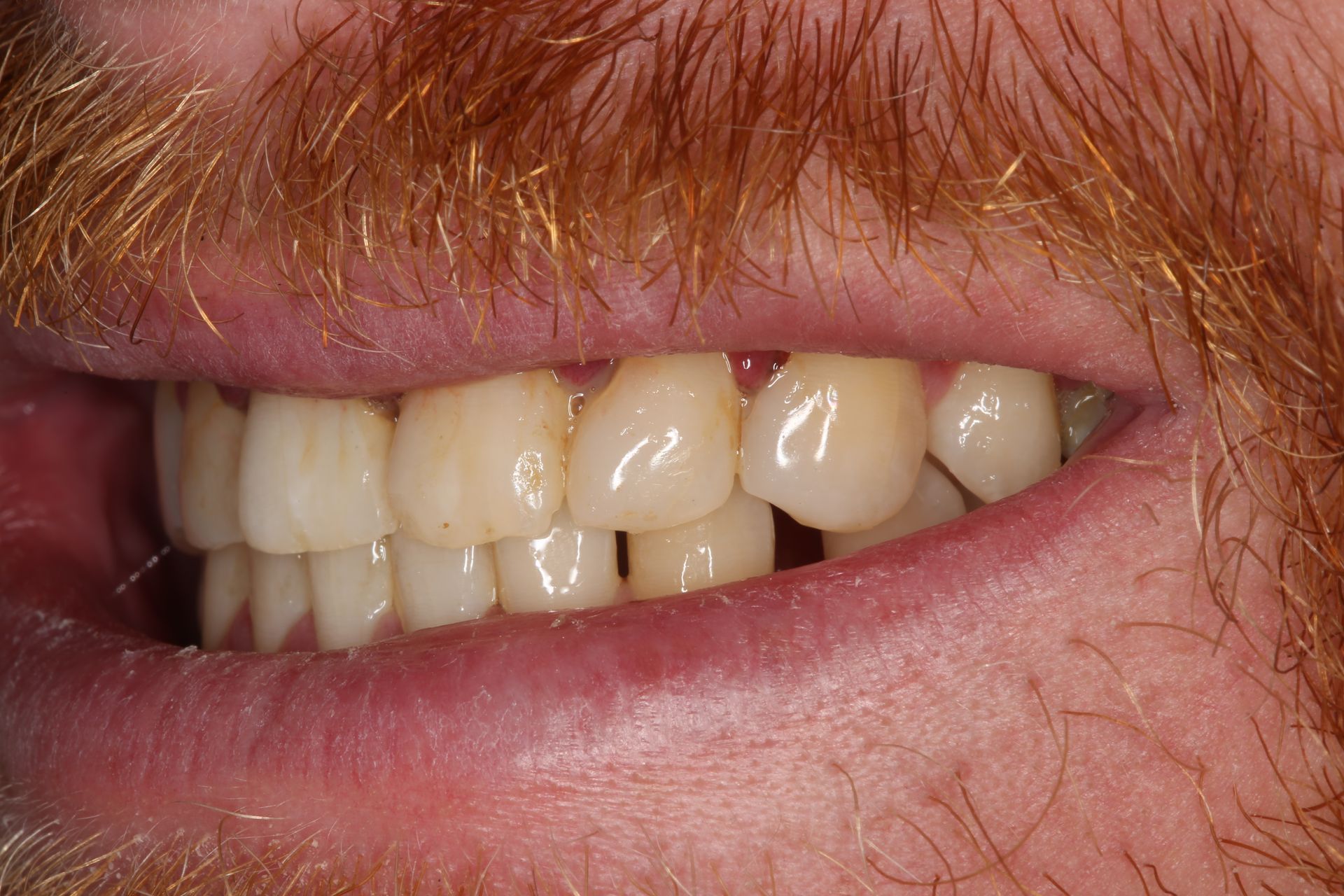 A side view of a person’s mouth showing their teeth, with a visible gap between the lower and upper teeth.