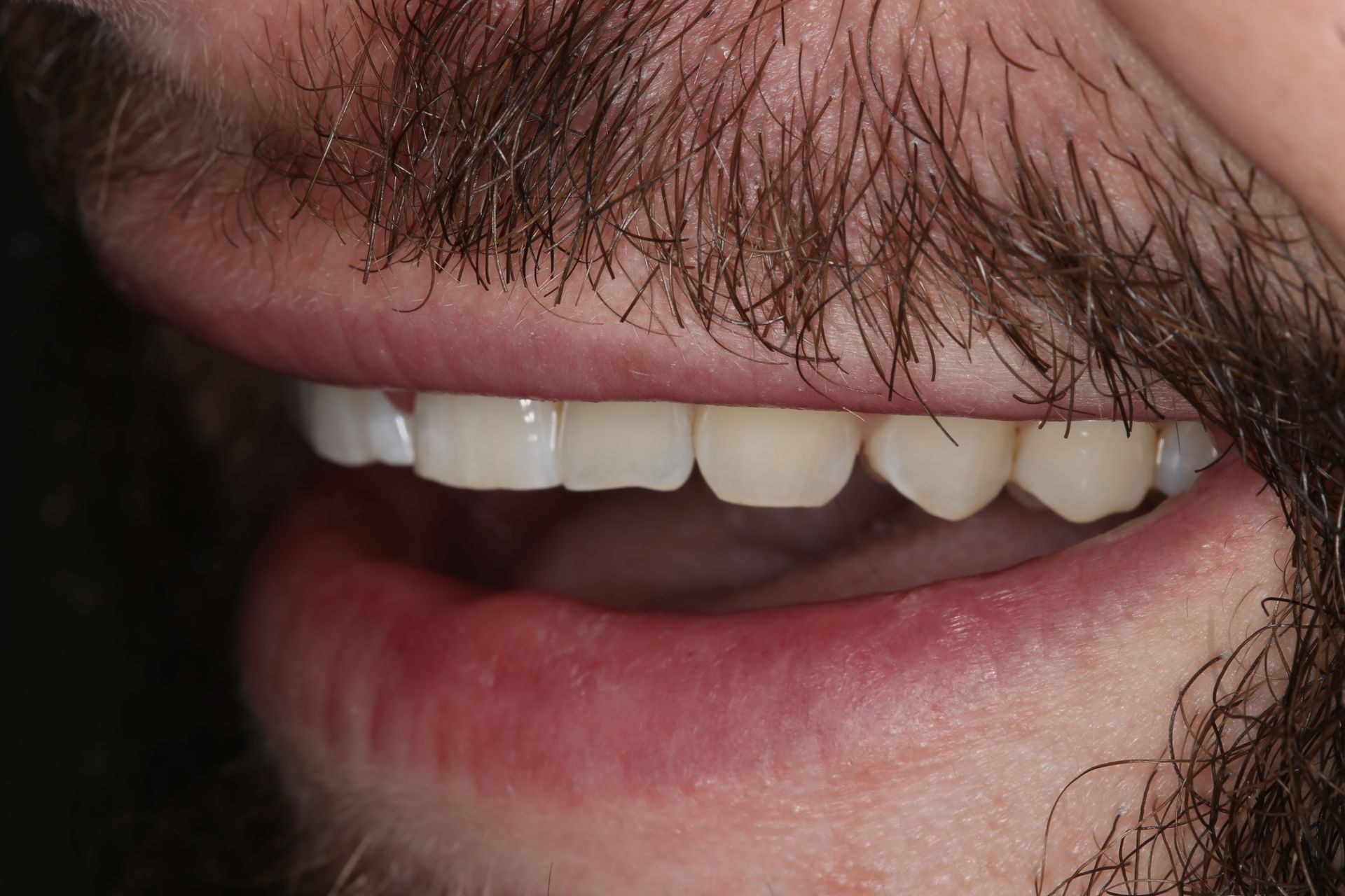 A side-view close-up of a person's mouth with white, straight teeth partially visible behind a mustache and beard.