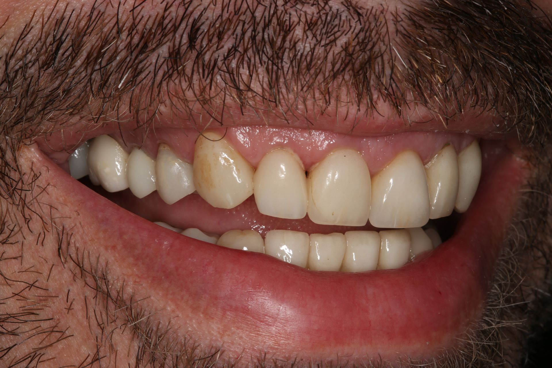 A close-up of a person's mouth with teeth showing, including one discolored upper tooth.