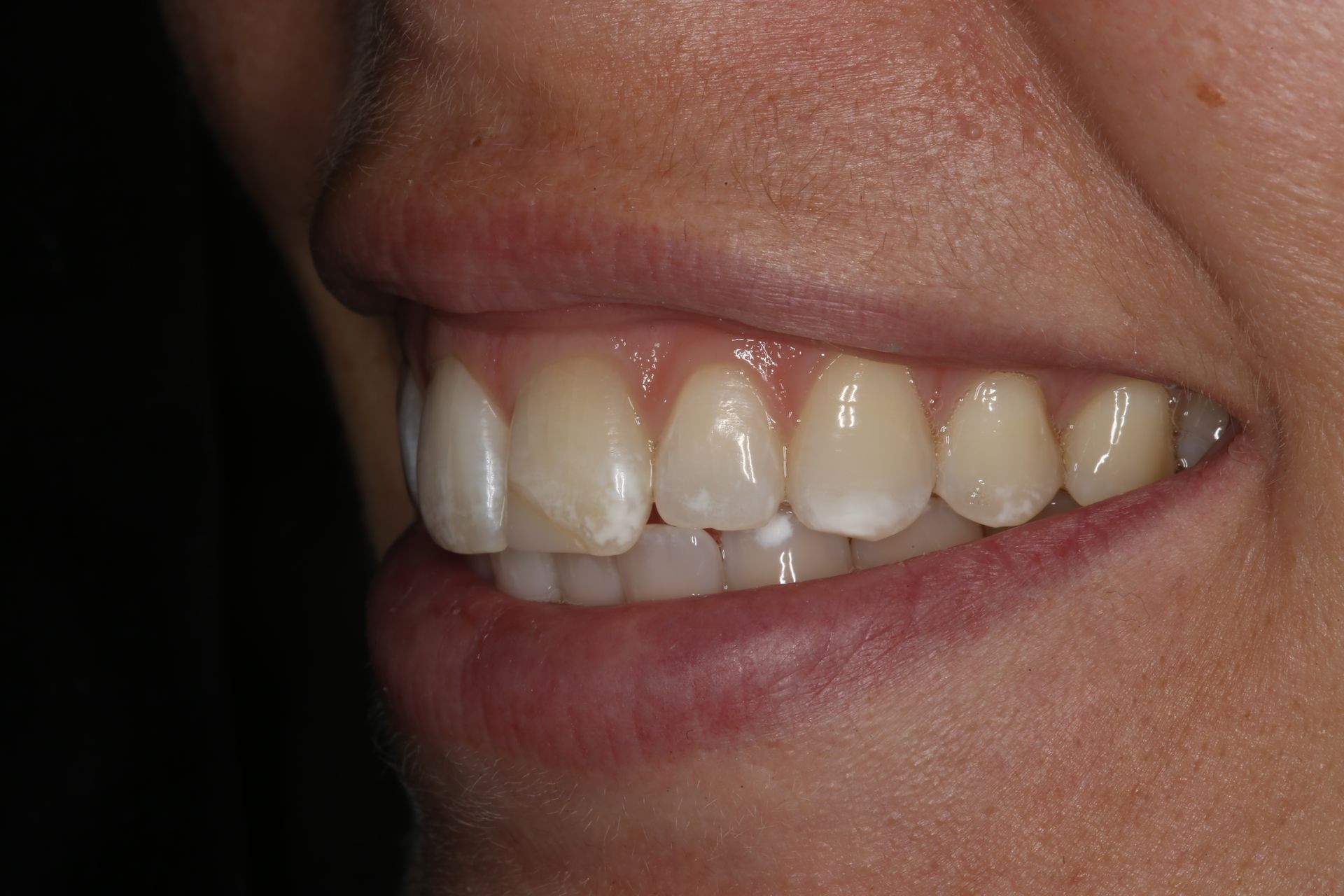 Side view of a person smiling, showing teeth with mild white spot discoloration on the enamel of the front teeth.