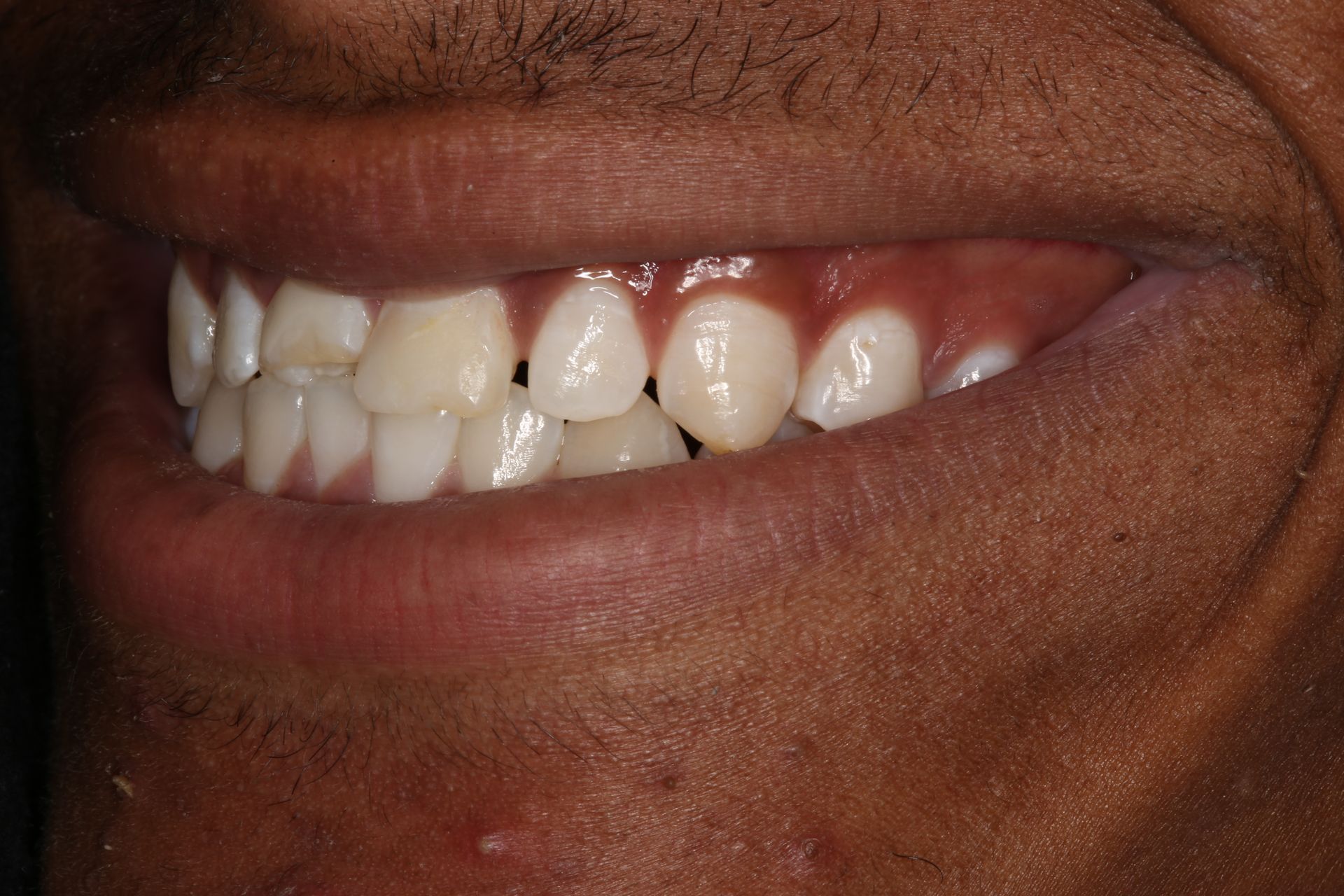 A close-up profile view of a person smiling, showcasing their teeth and dental alignment.