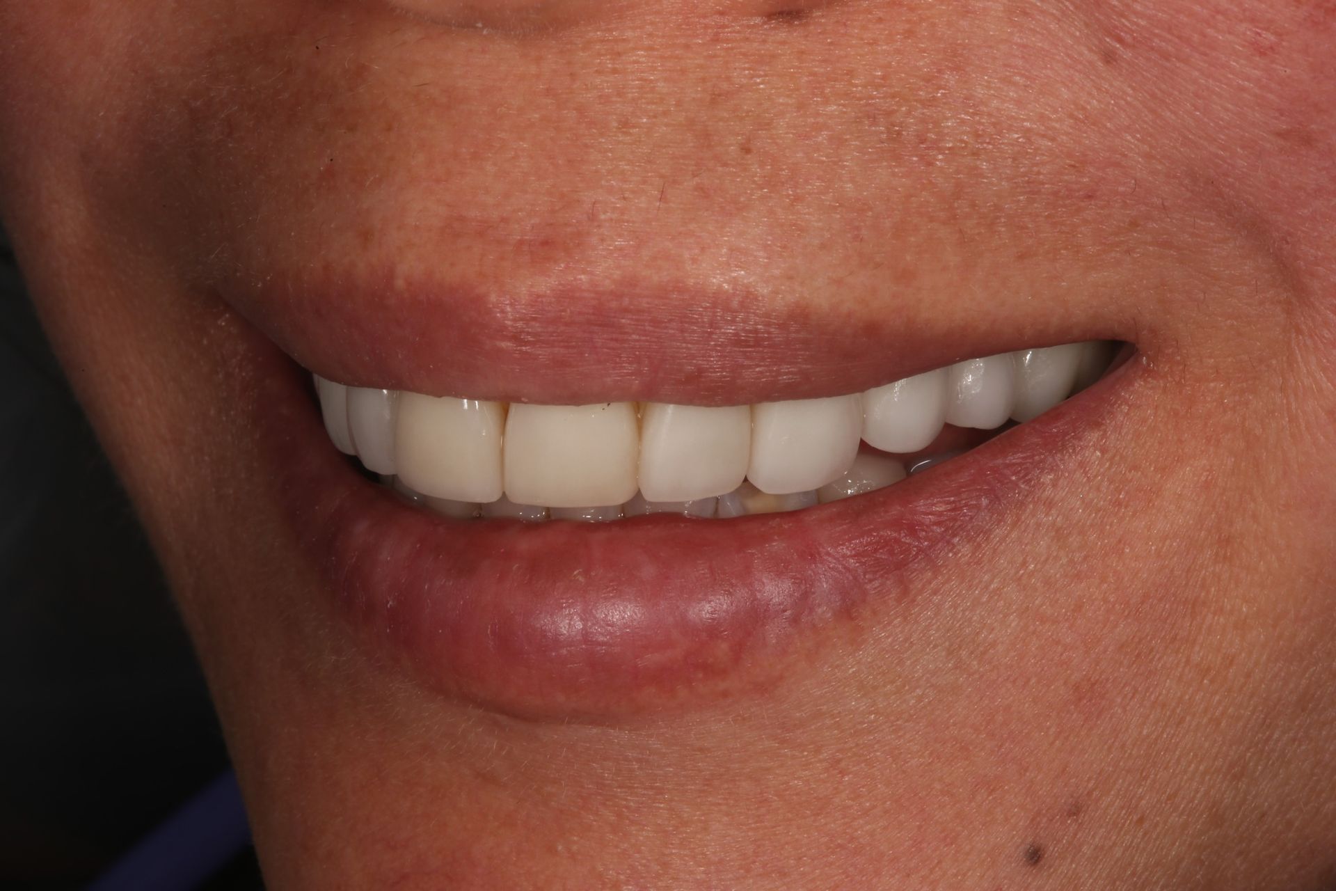 A close-up view of a person’s lower face showing an even, bright white smile with aligned teeth.