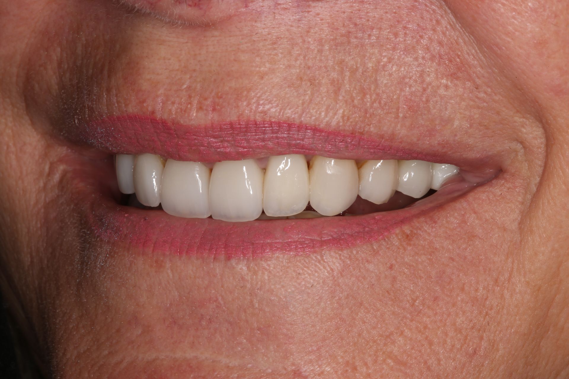 A close-up view of a person smiling, showing a full set of white, well-aligned teeth and gums.
