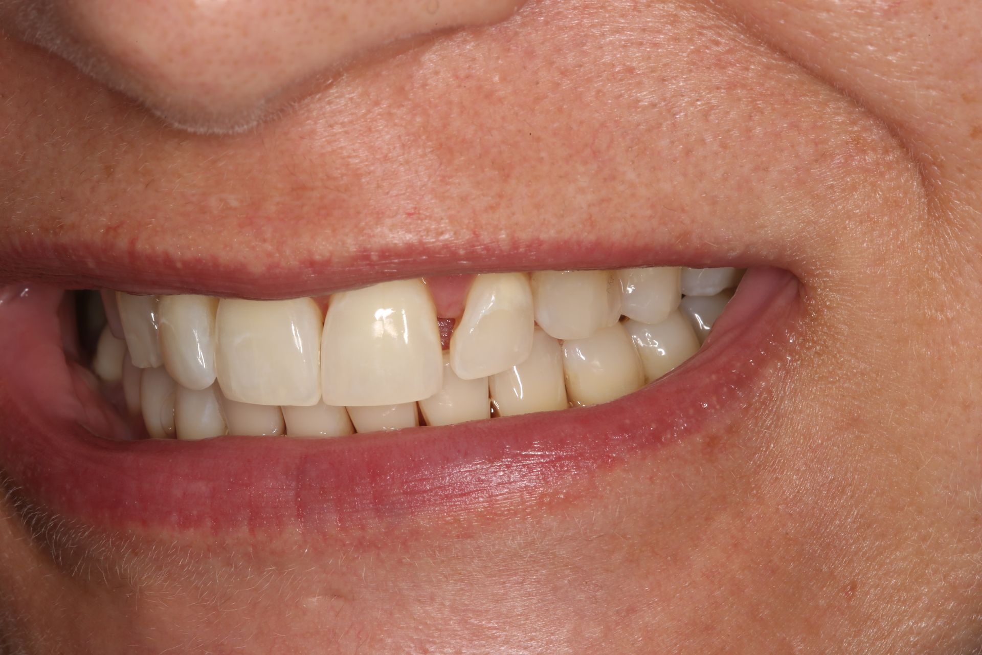 A close-up of a person's mouth showing slightly misaligned upper front teeth with a small gap.