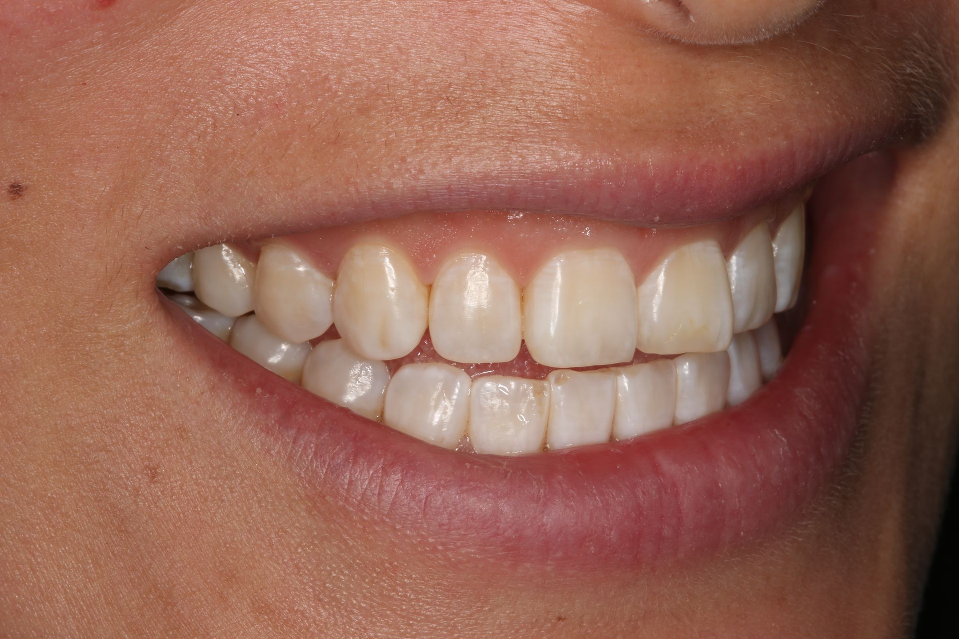 A close-up view of a smiling mouth showing a natural set of white teeth and healthy gums.