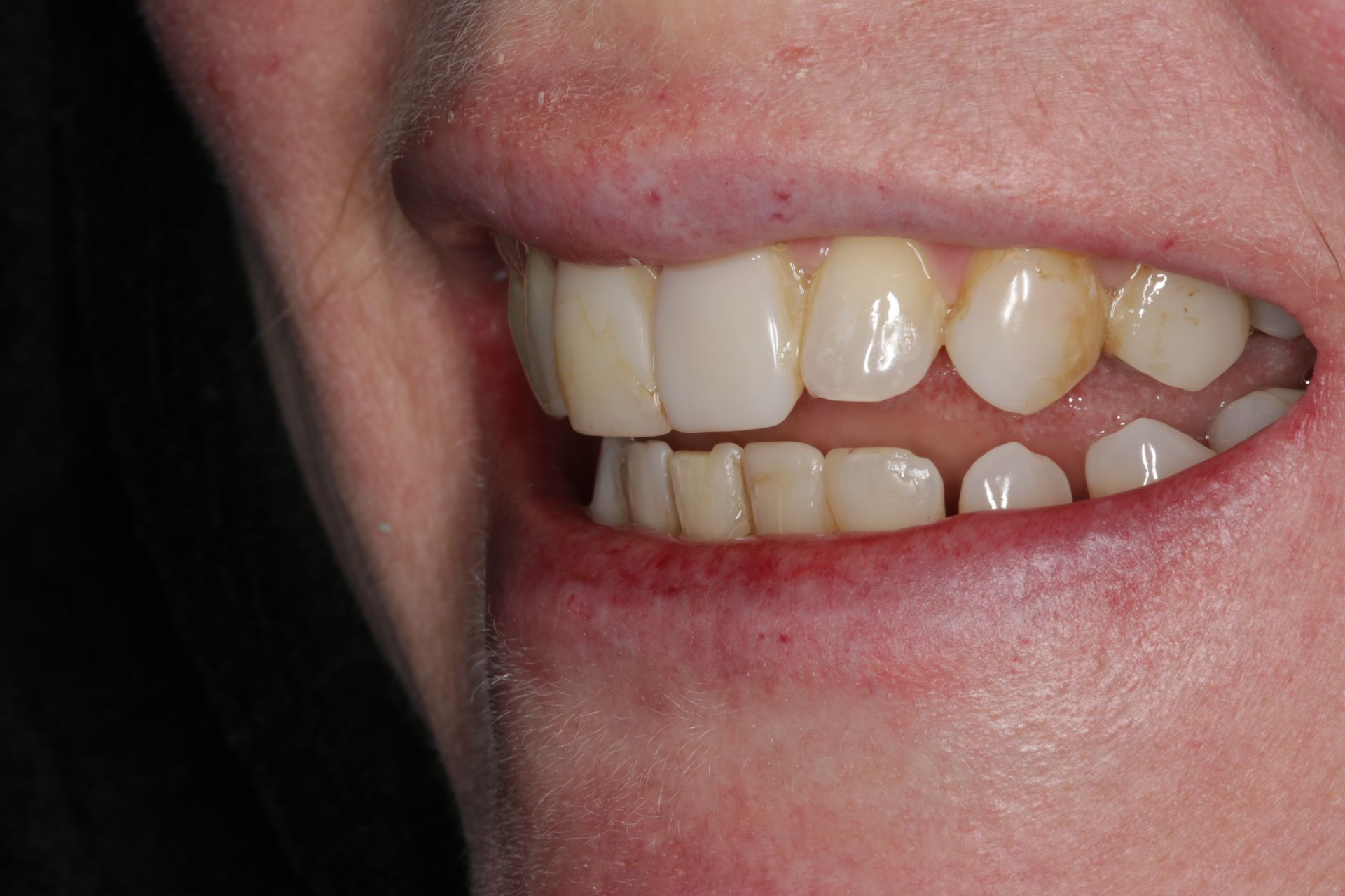 Close-up view of a person’s mouth showing upper and lower teeth, with a visible gap between the top and bottom rows.