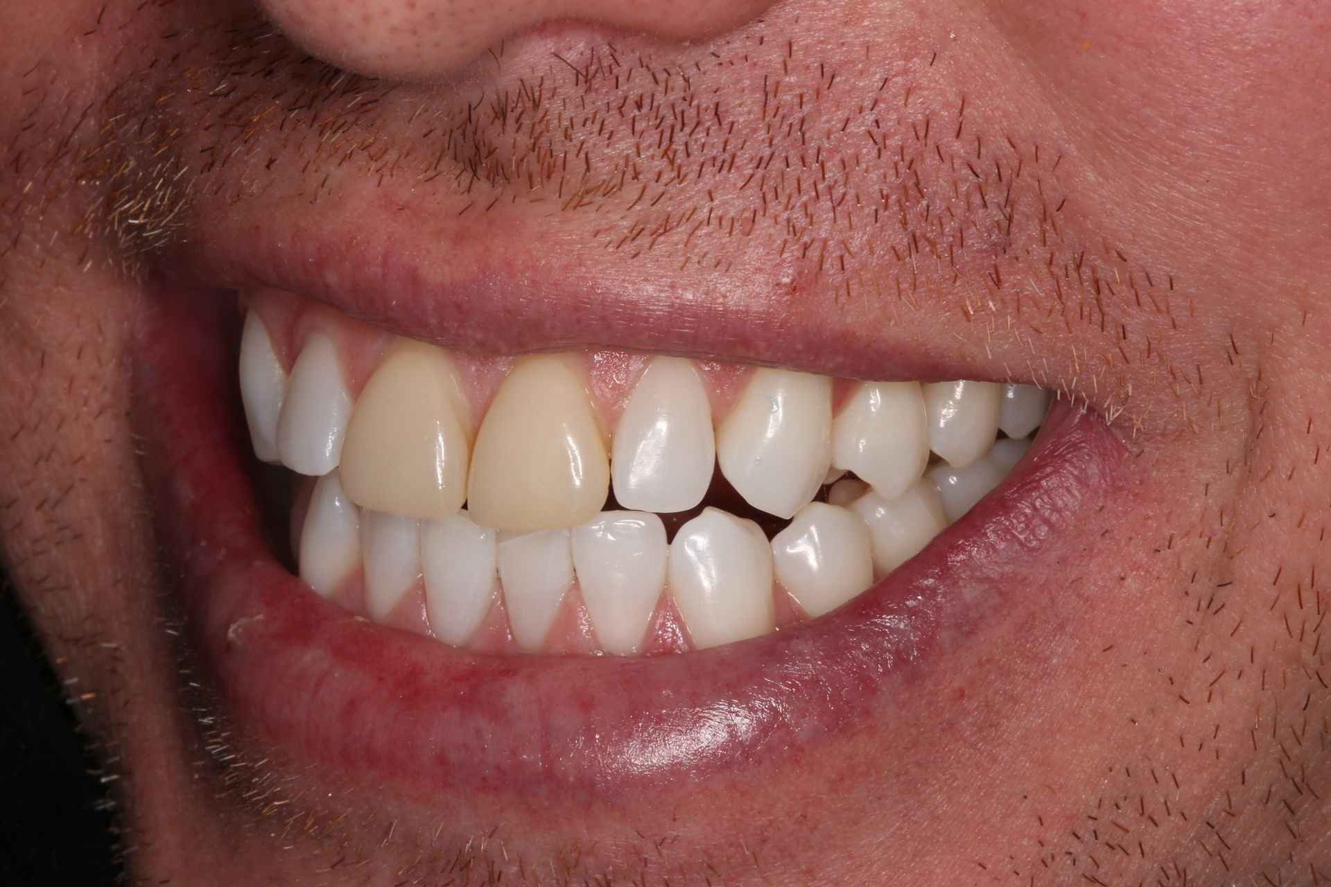 A close-up of a person's smile, showing two discolored, yellowish-toned upper teeth among otherwise white teeth.