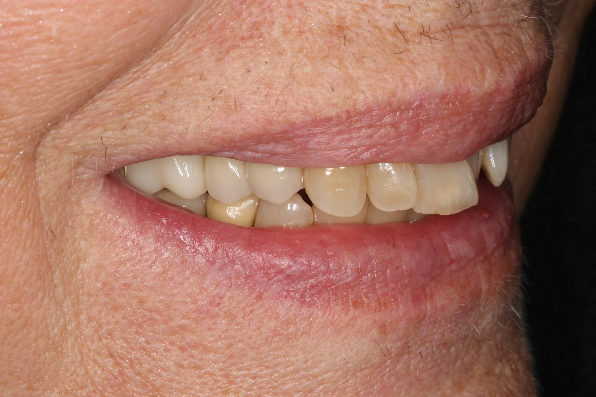 Close-up profile of a person smiling, showing teeth with some variations in shade and alignment.