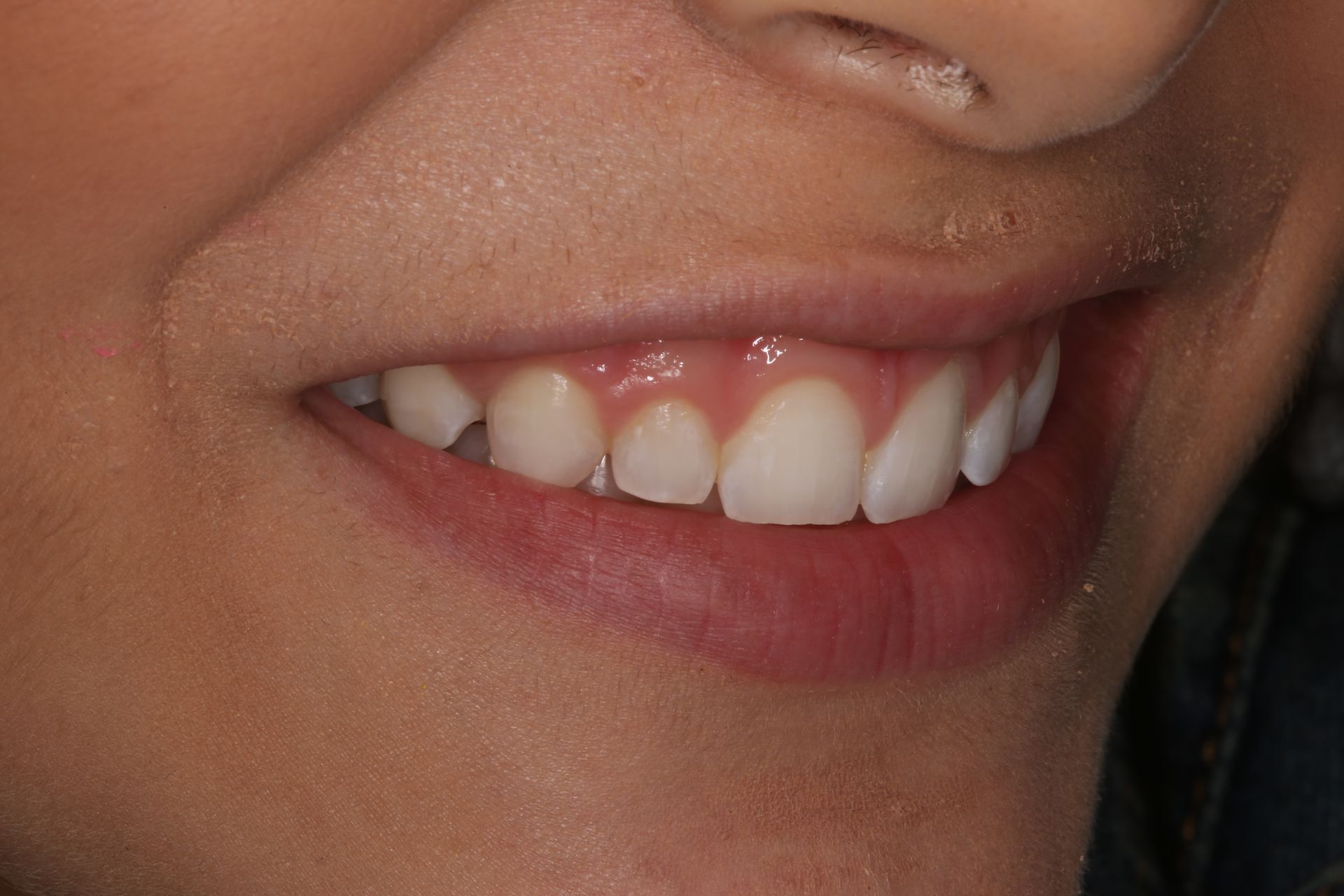 Close-up of a person's mouth with white teeth, highlighting a gummy smile with exposed gum tissue above the upper teeth.