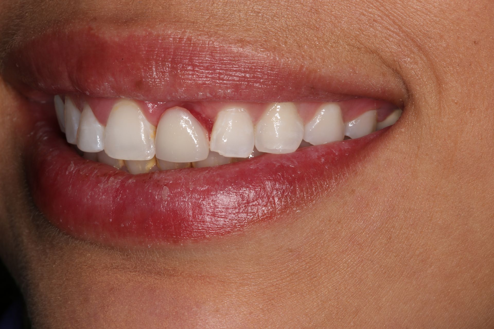 Close-up of a person's smile showing white teeth and healthy gums.