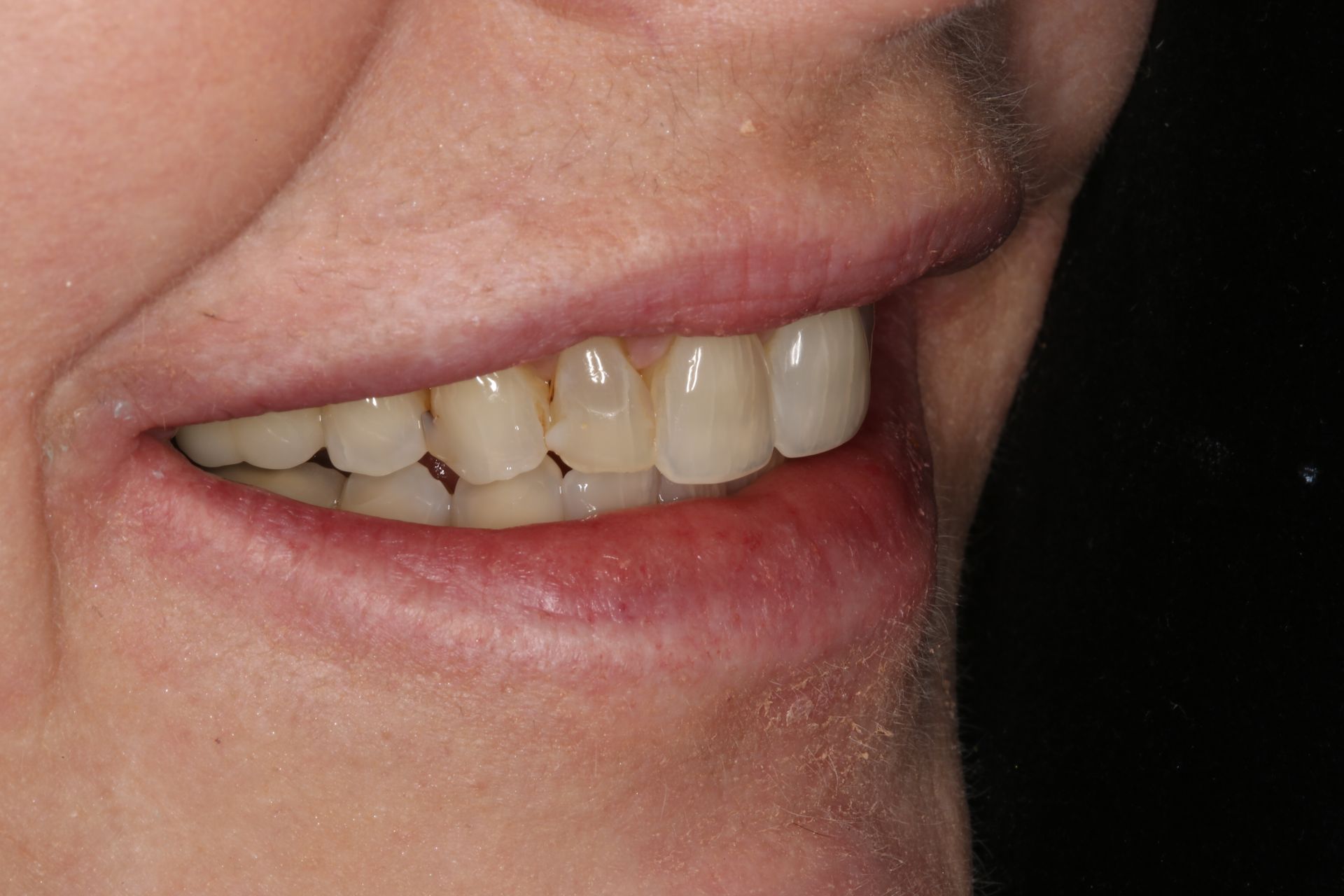 A close-up view of a person’s lower face, focusing on their teeth and smile.