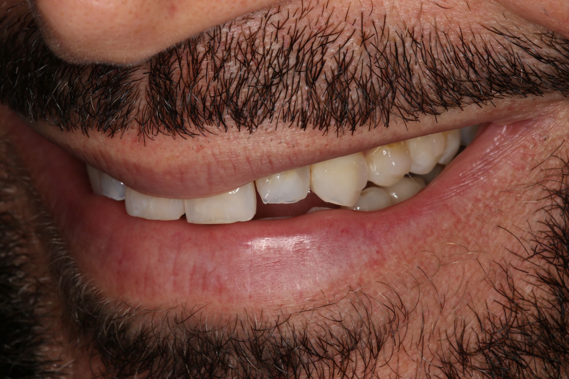 Close-up of a person's mouth and lower face, showing a smile with a visible gap between the two front upper teeth.