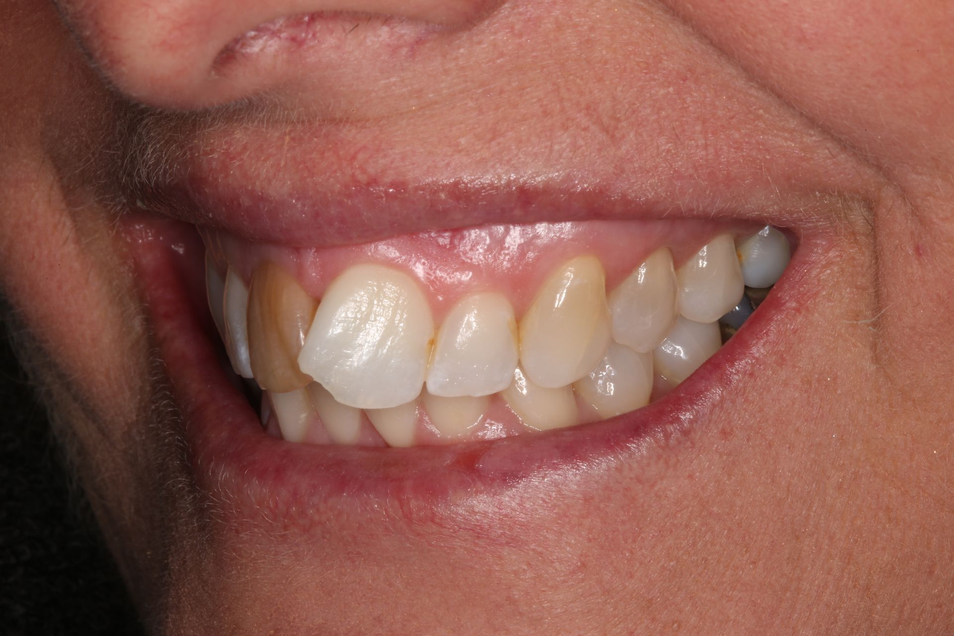 A close-up of a person's smile, showing slightly crowded, natural-toned teeth and a discolored upper lateral incisor.