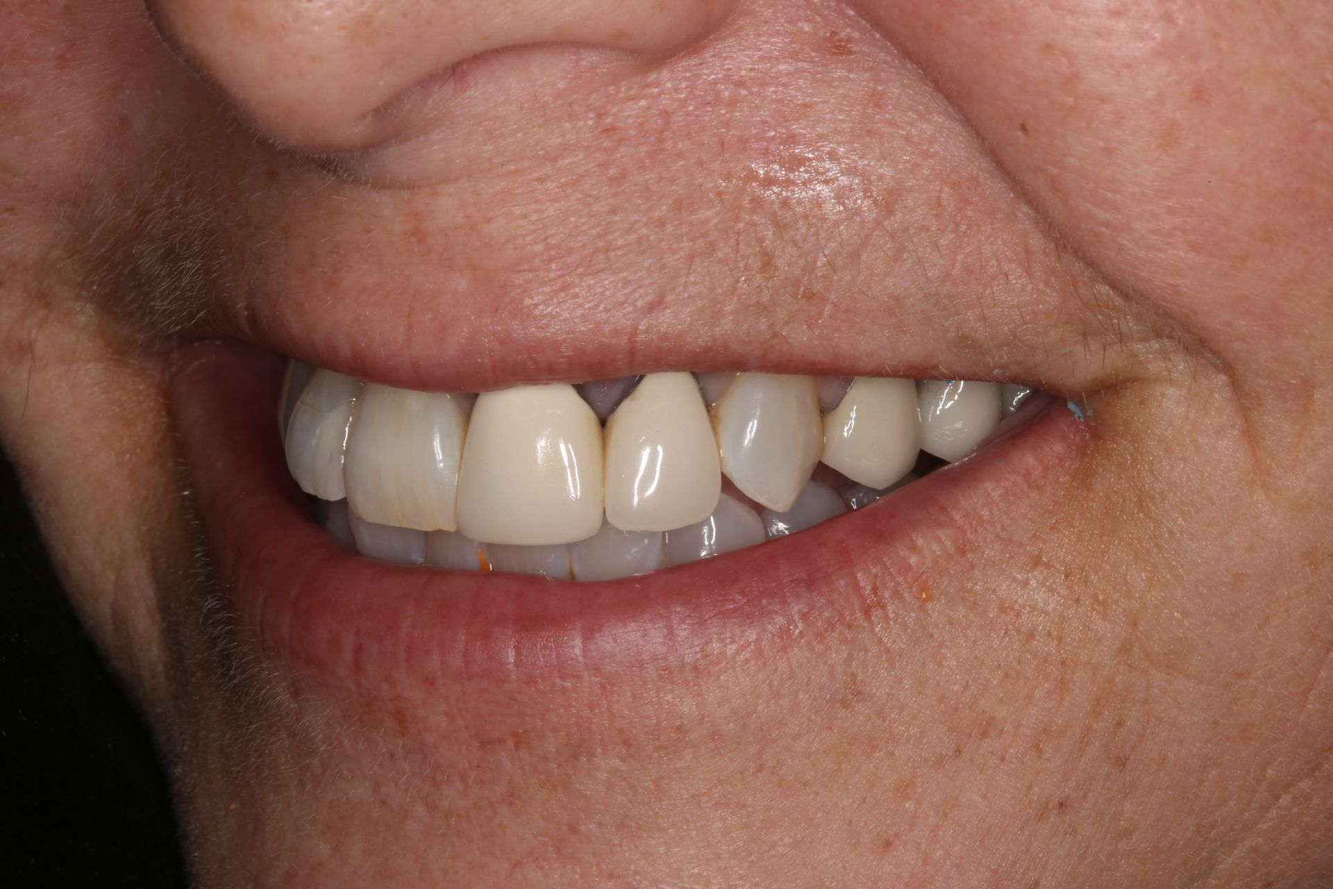 Close-up of a person's mouth showing upper front teeth with dental crowns and natural teeth.