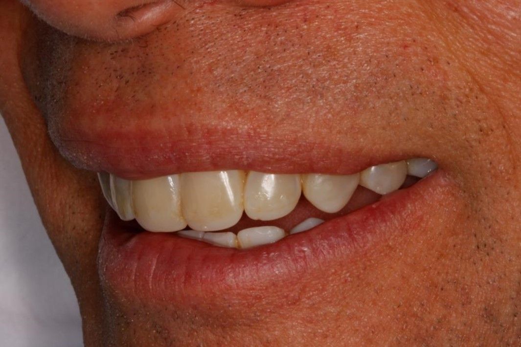 Close-up of a person's mouth showing the side profile of their upper and lower teeth while smiling.