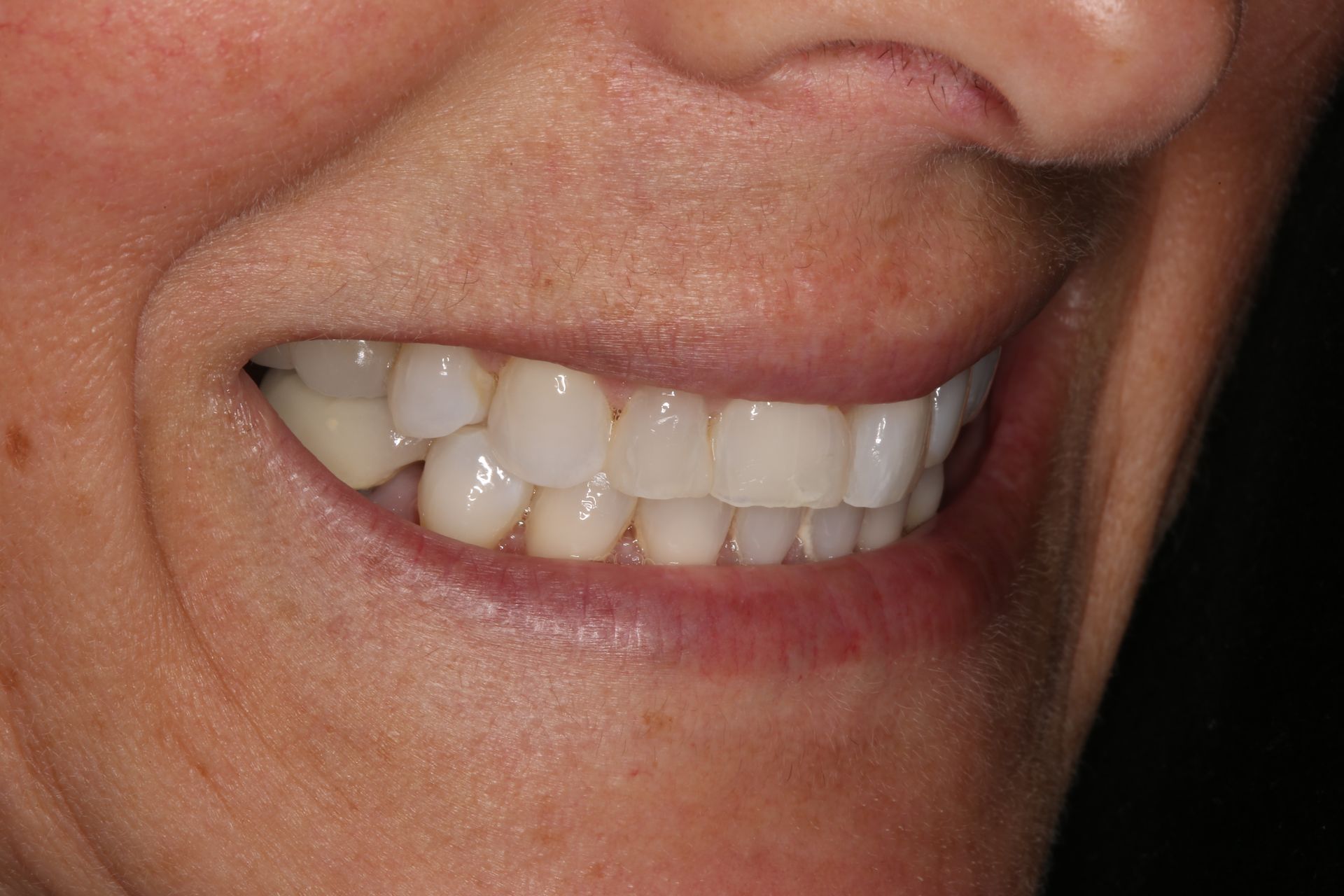 A close-up view of a smiling mouth showing a set of white teeth.