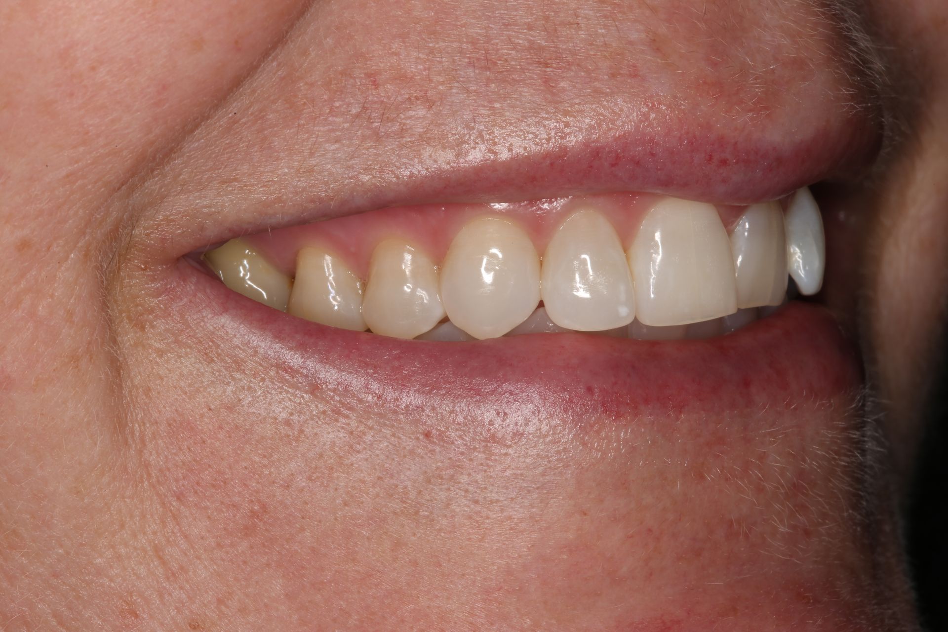 A close-up view of an individual's lower face, showing straight, white teeth while smiling.